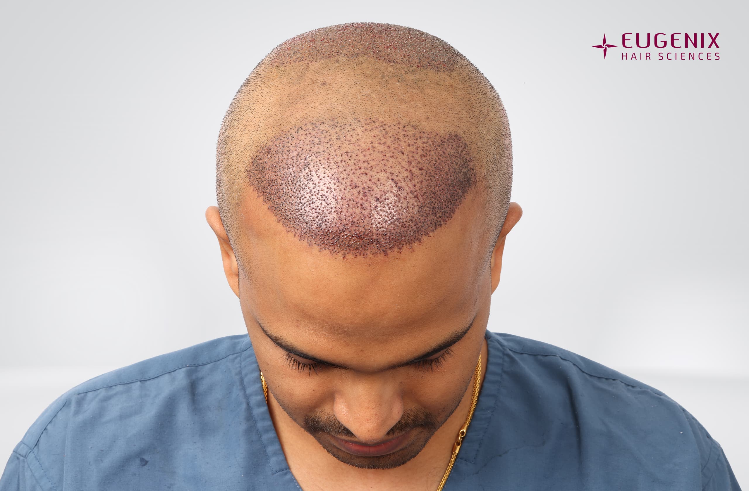 Sanket Sanjay Achari Post-op Head Down copy