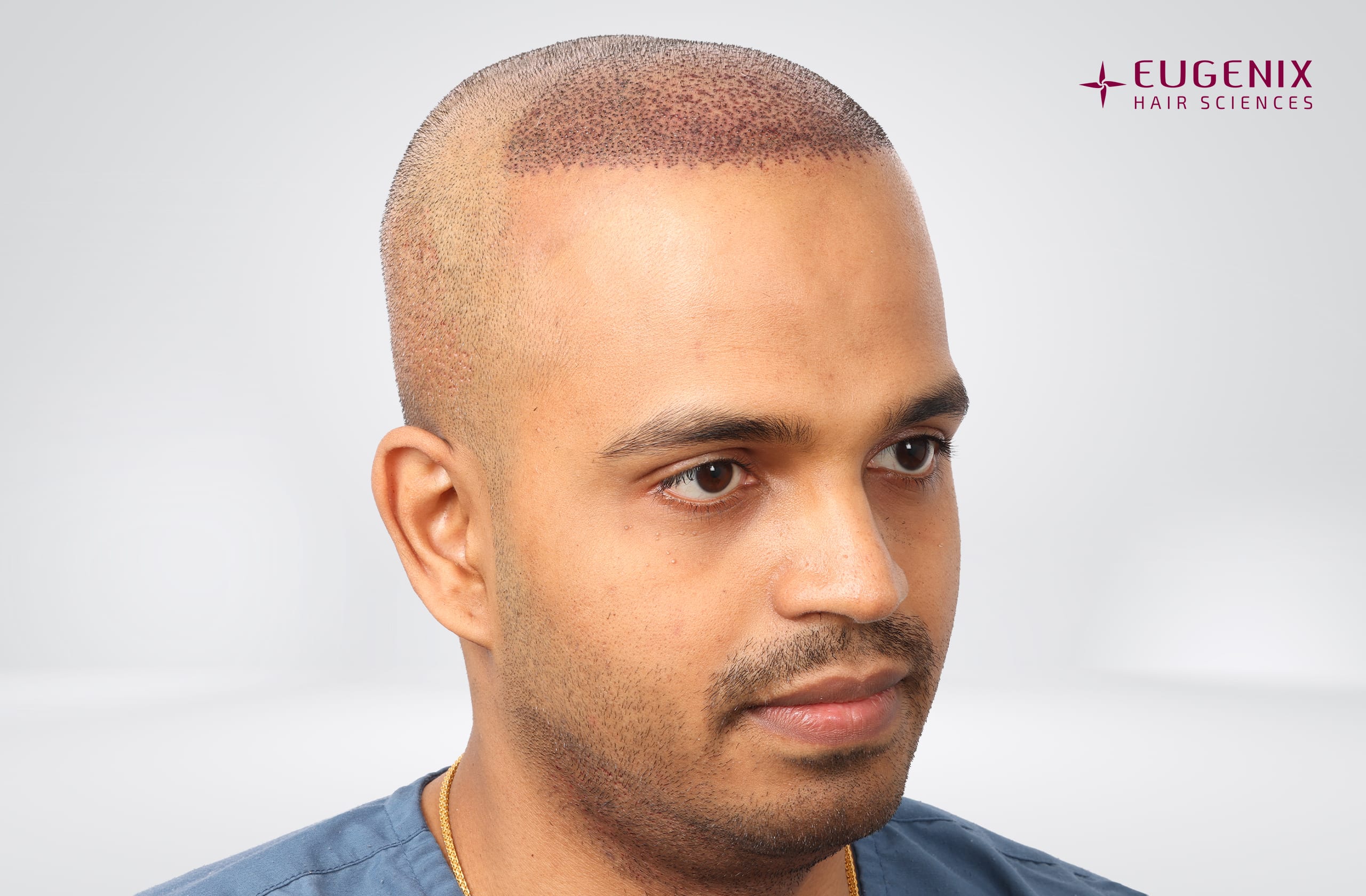 Sanket Sanjay Achari Post-op Left copy