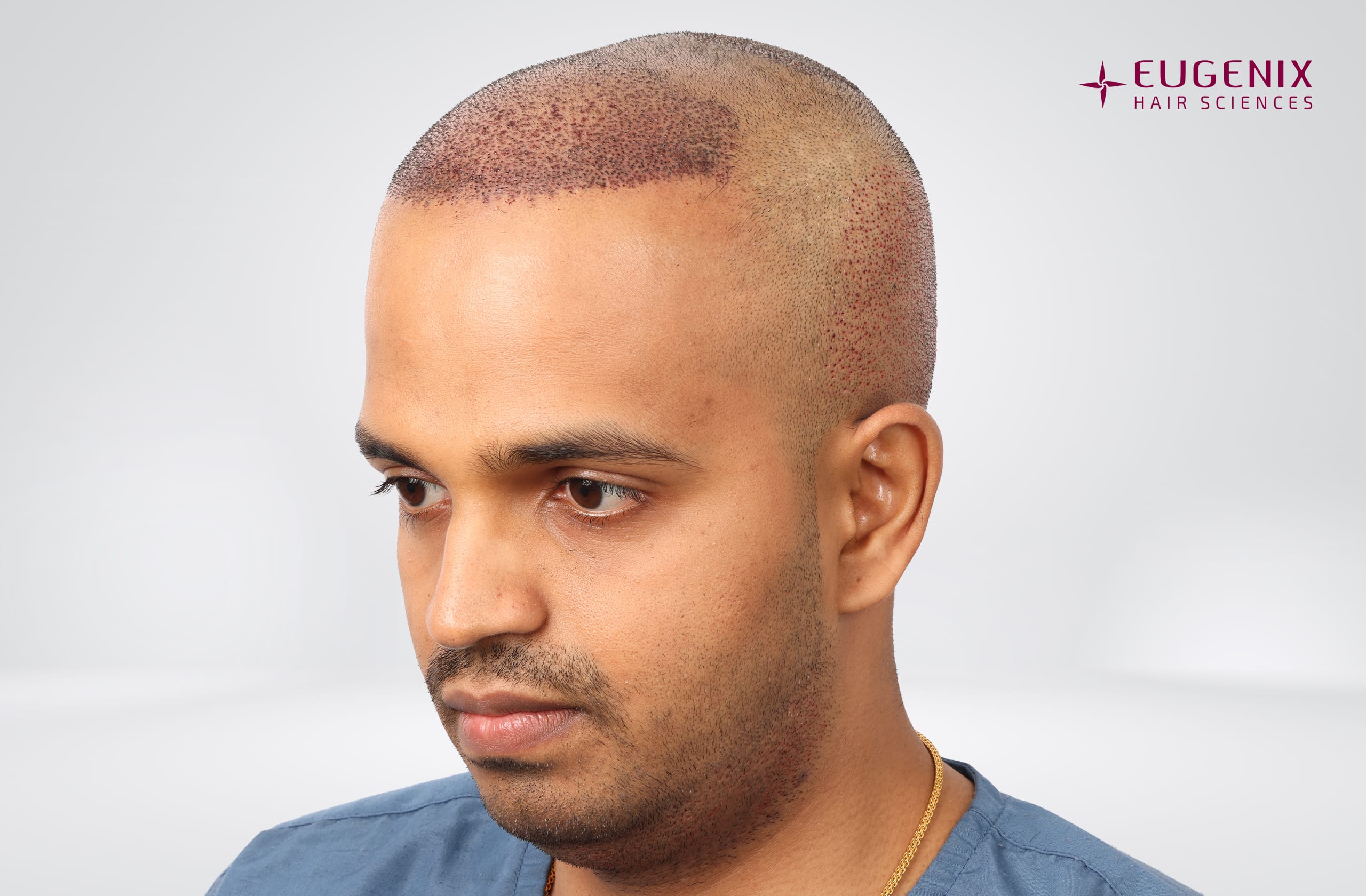 Sanket Sanjay Achari Post-op Right copy
