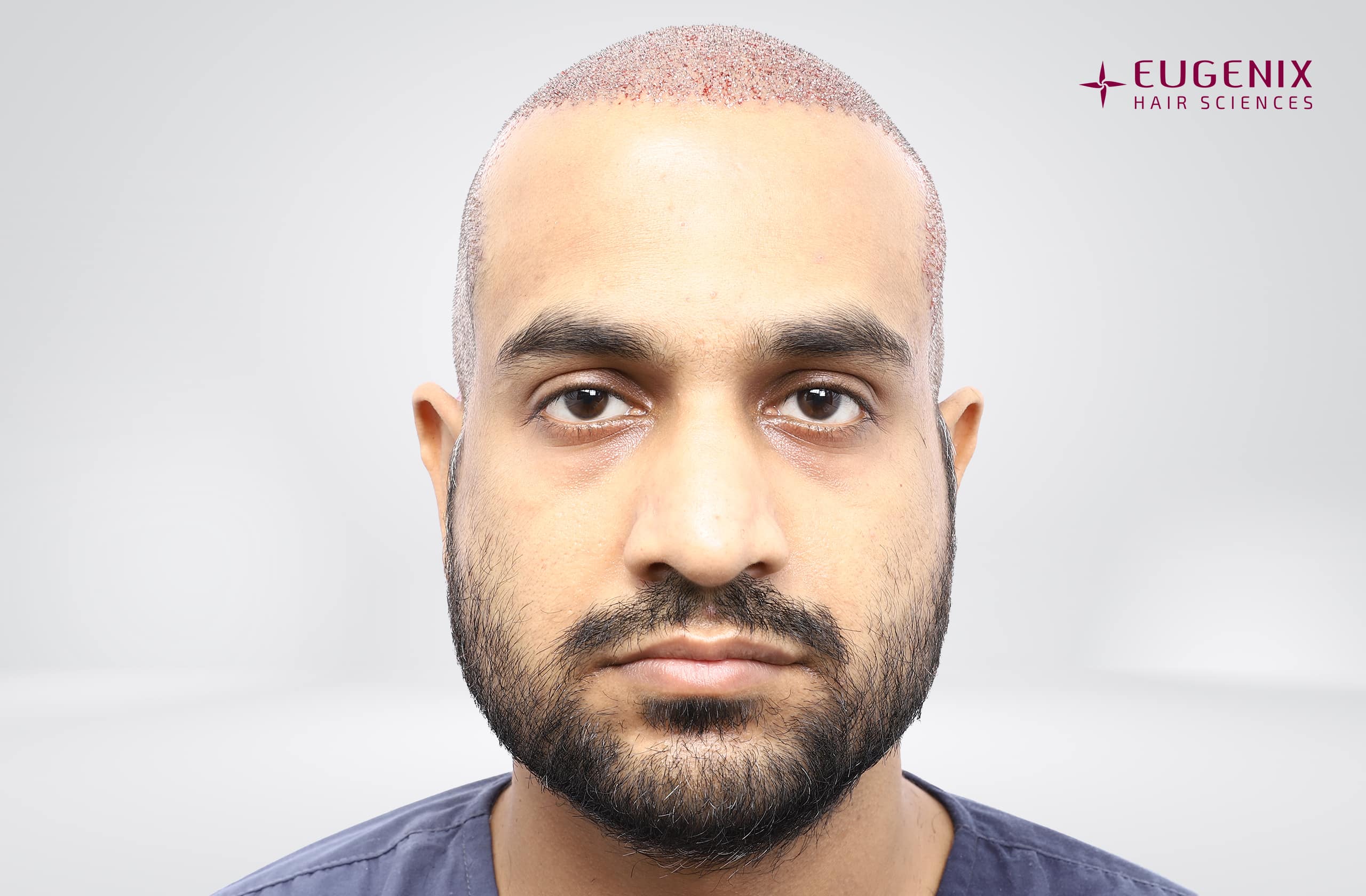 Saurabh Tiwari Post-op Front copy