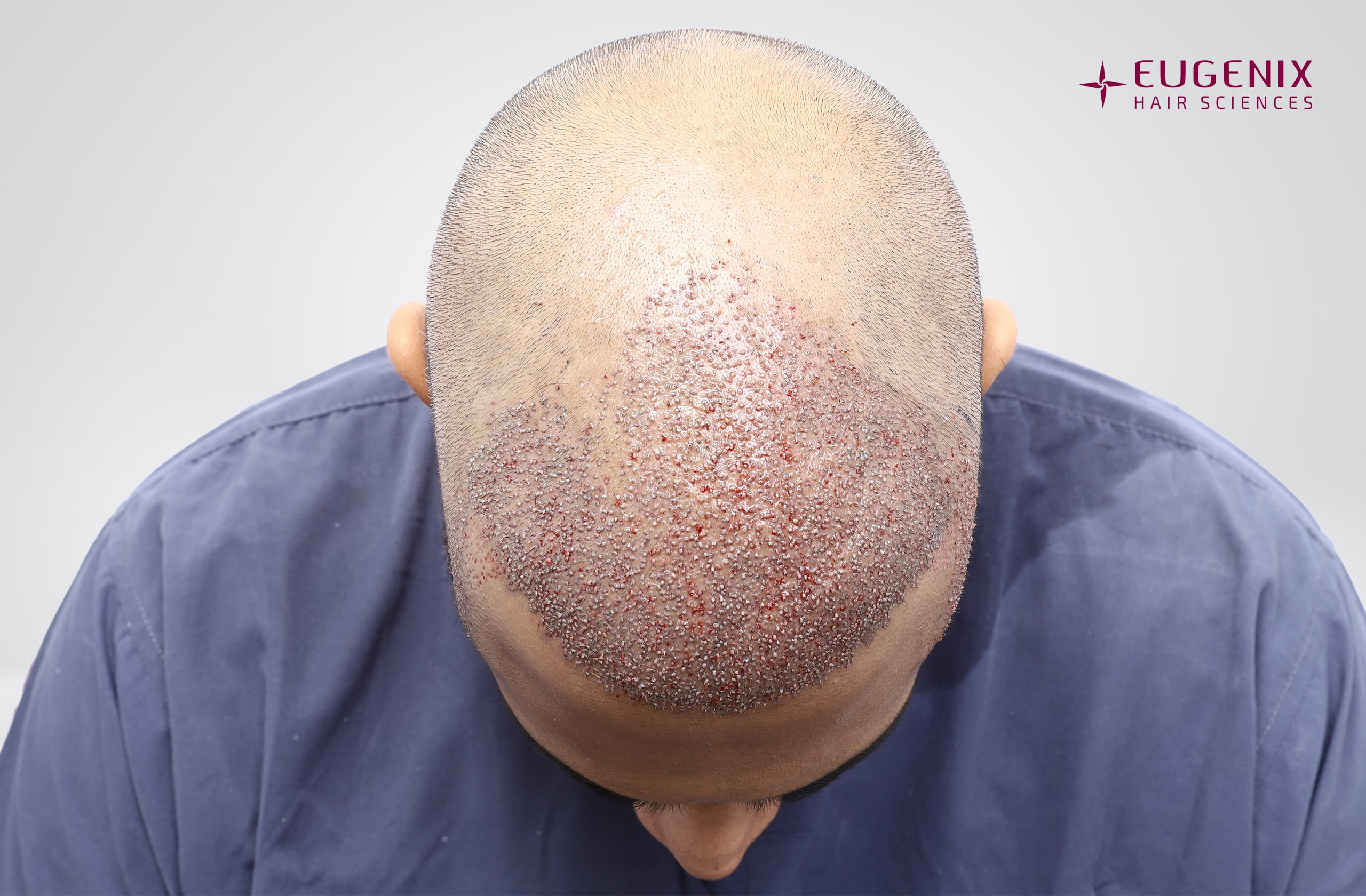 Saurabh Tiwari Post-op Head Down copy