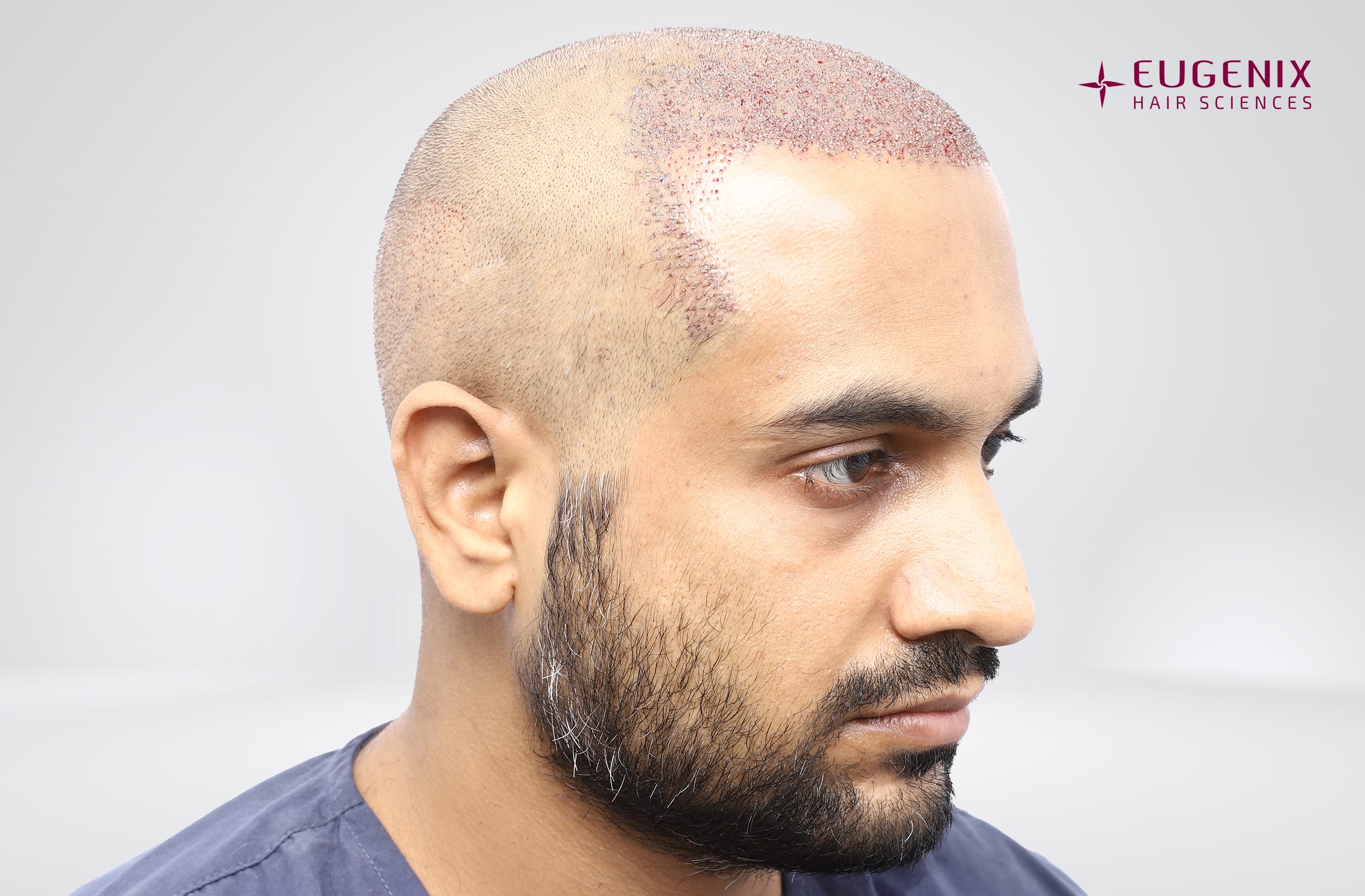 Saurabh Tiwari Post-op Left copy