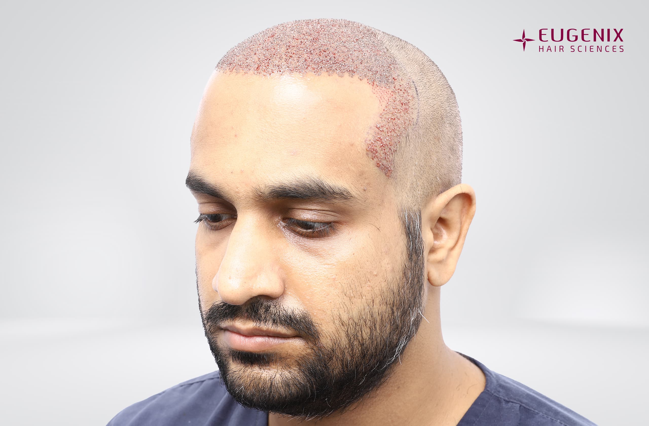 Saurabh Tiwari Post-op Right copy