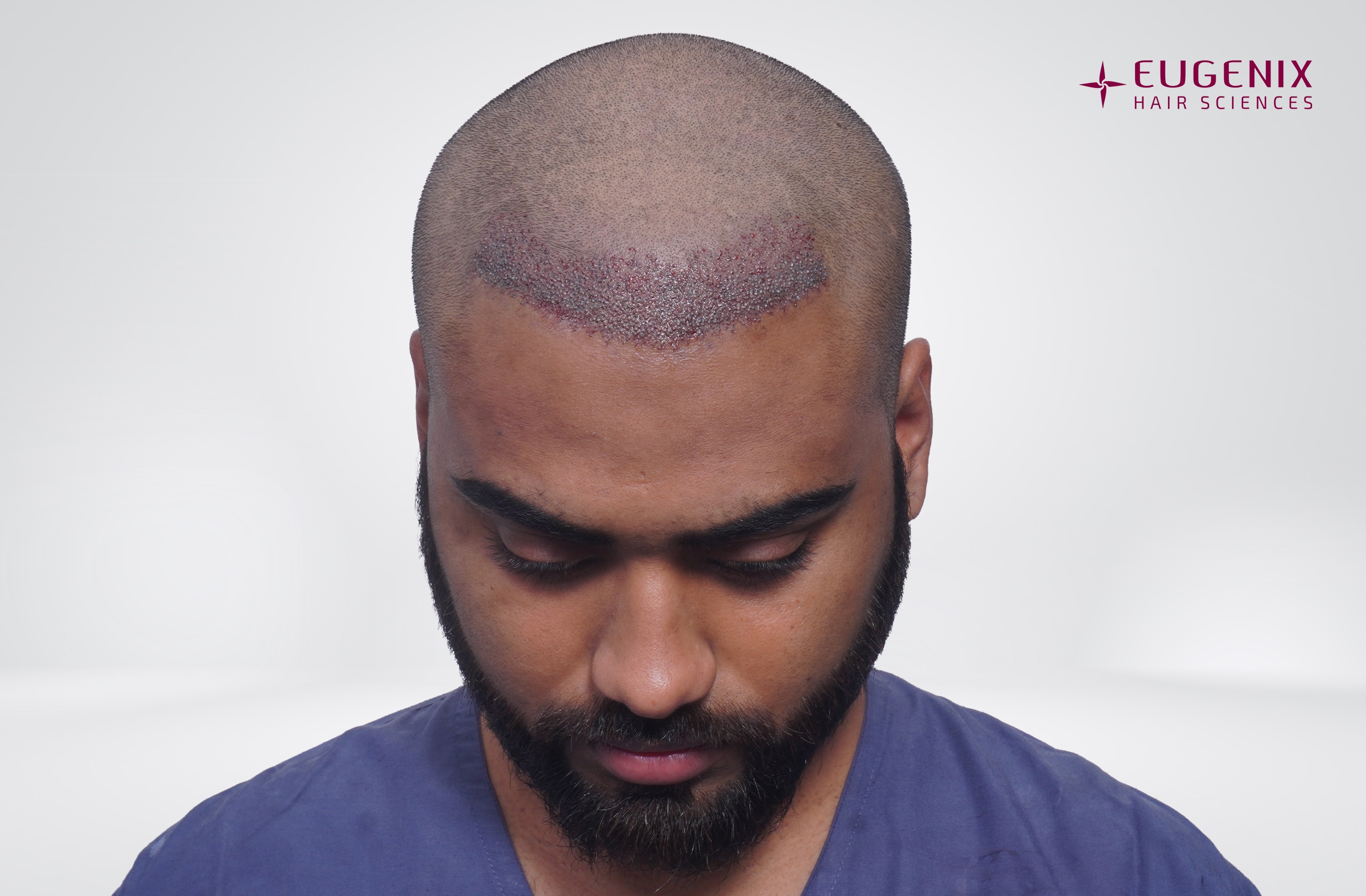 Soumyadeep Hazra Post-op Head Down copy