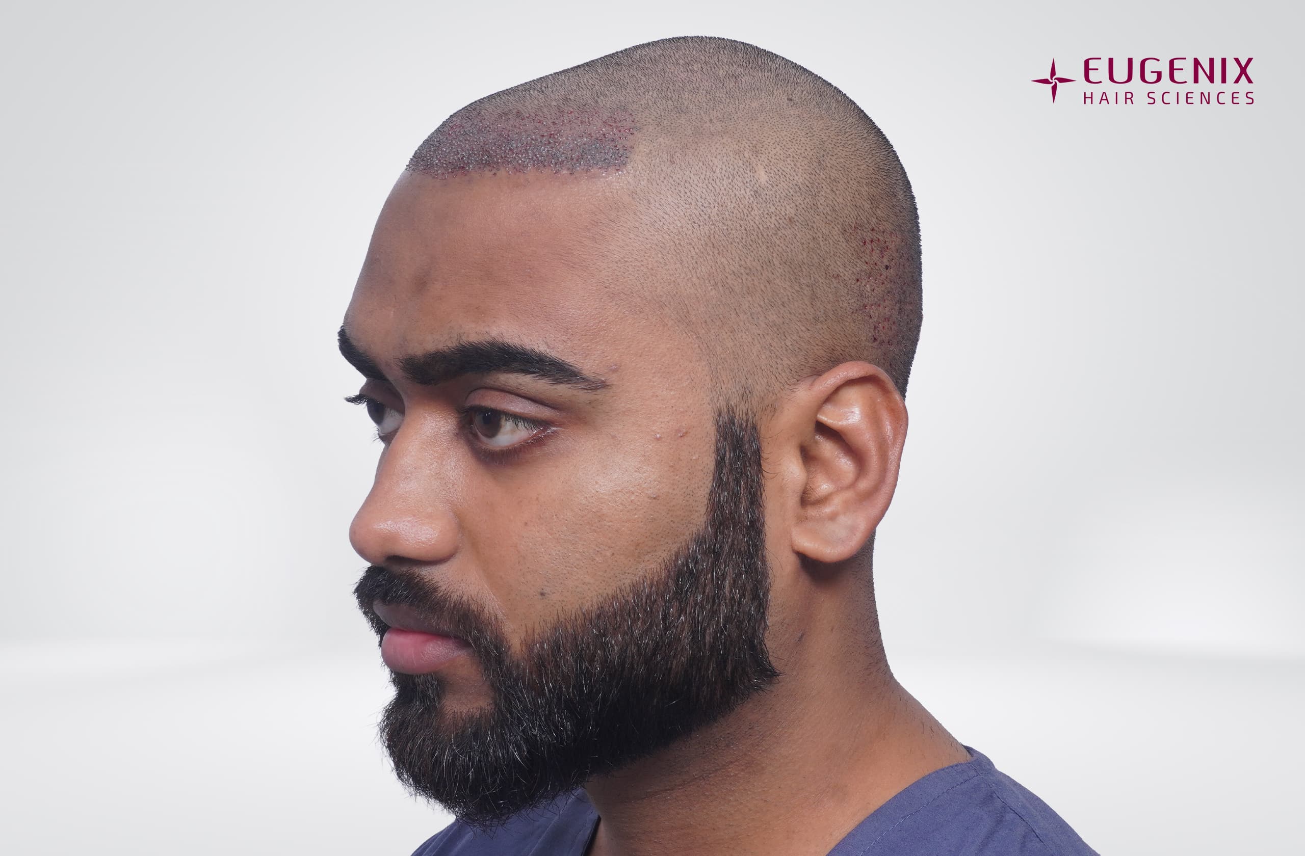 Soumyadeep Hazra Post-op Right copy