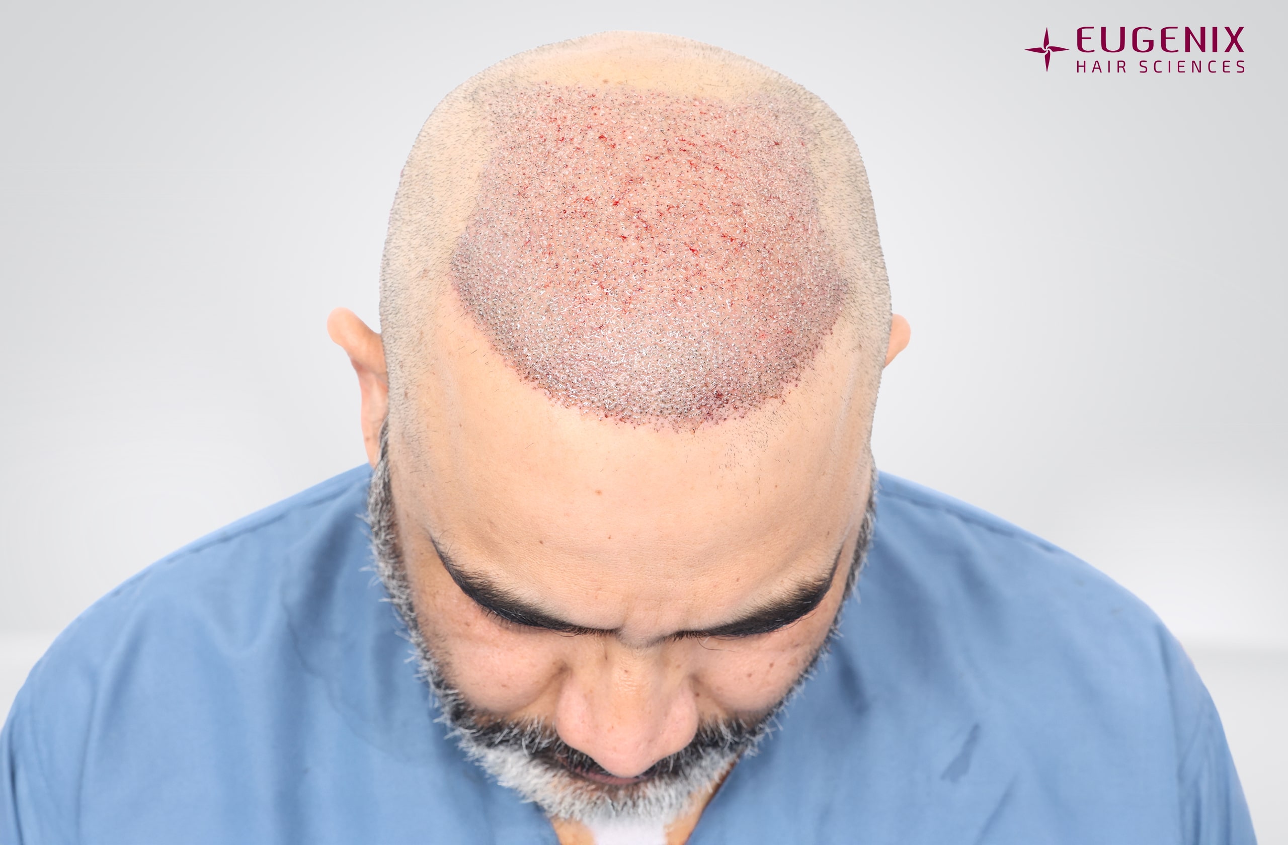 Vamshi Velma Post-op Head Down copy