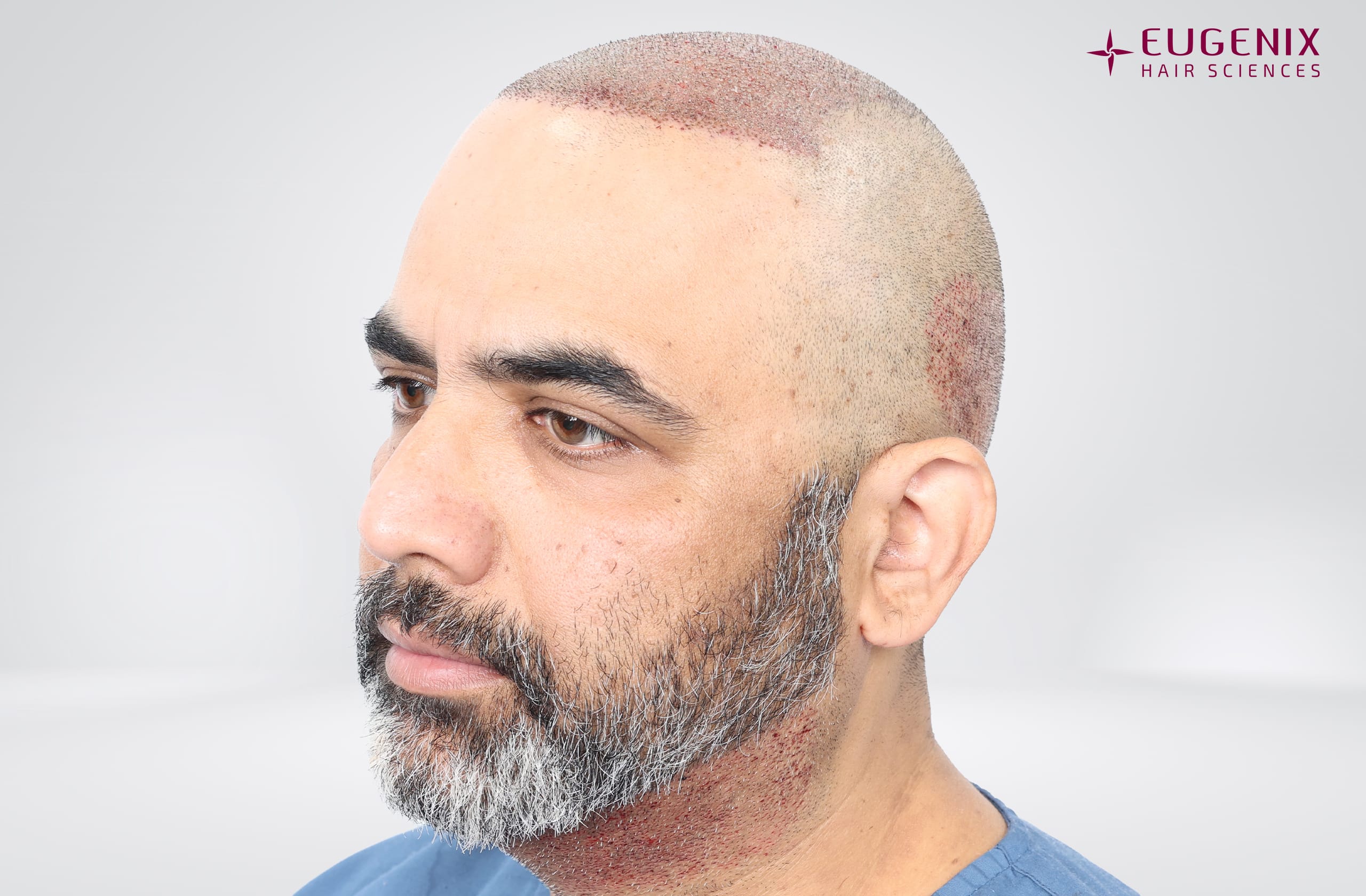 Vamshi Velma Post-op Right copy