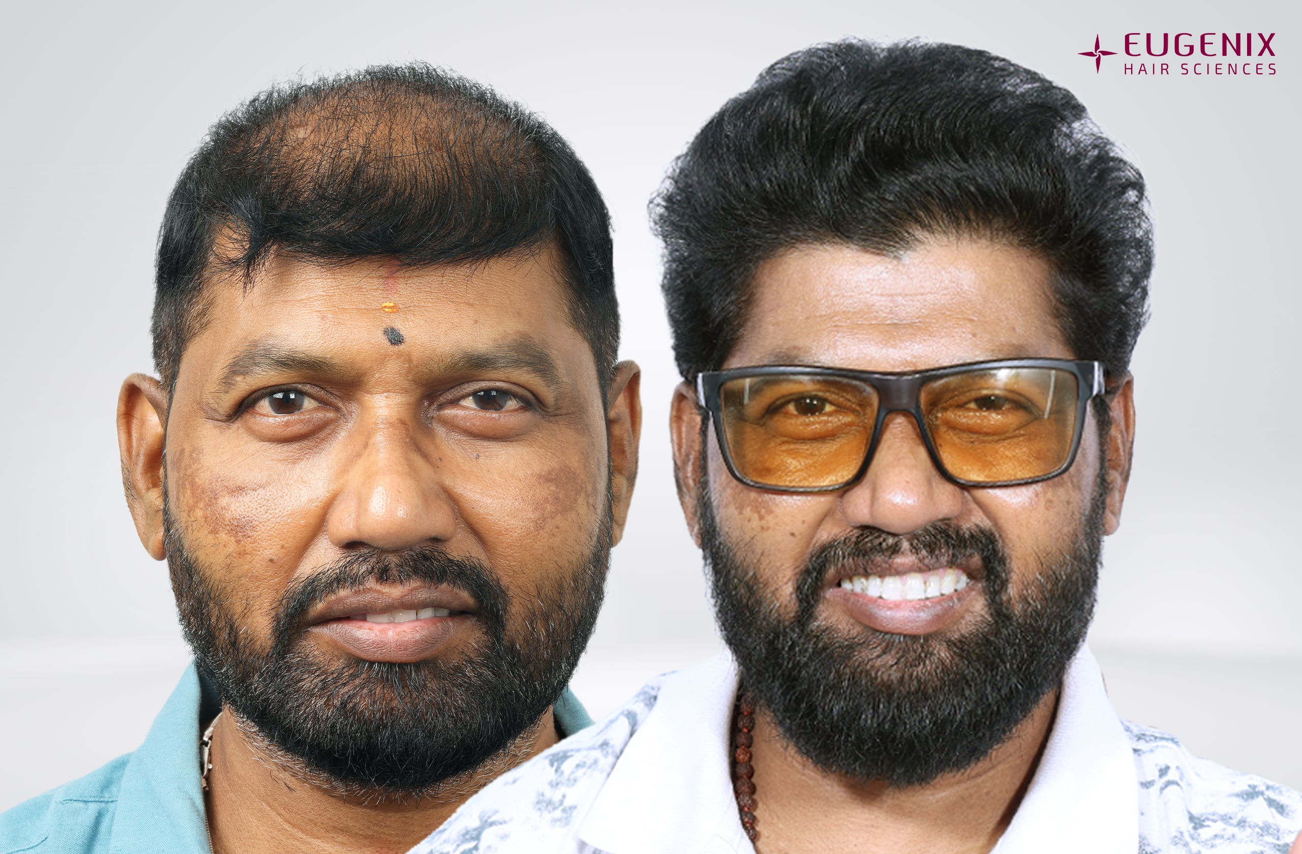 Prem Anand Front Before and After copy