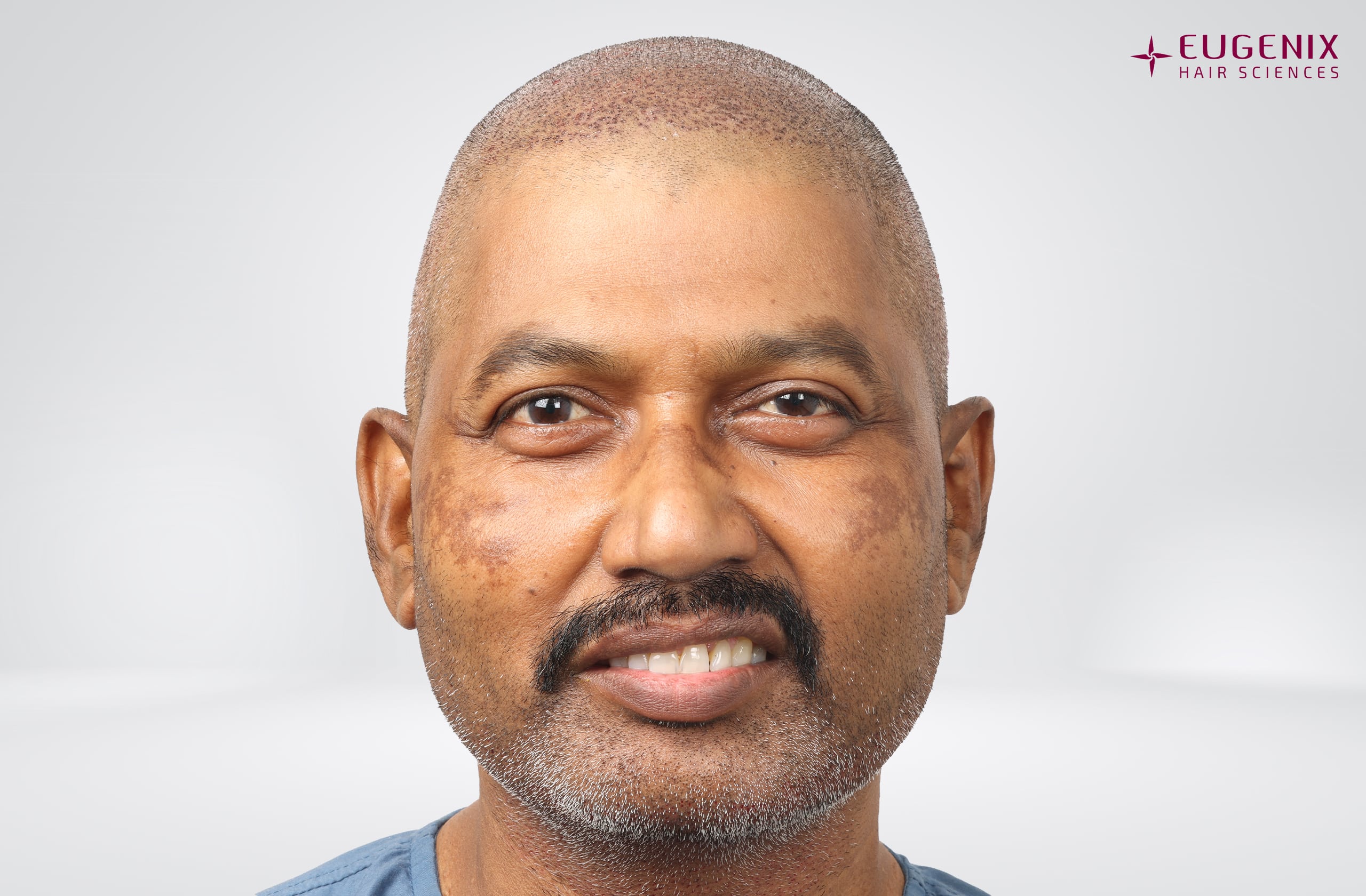 Prem Anand Front Post-op copy