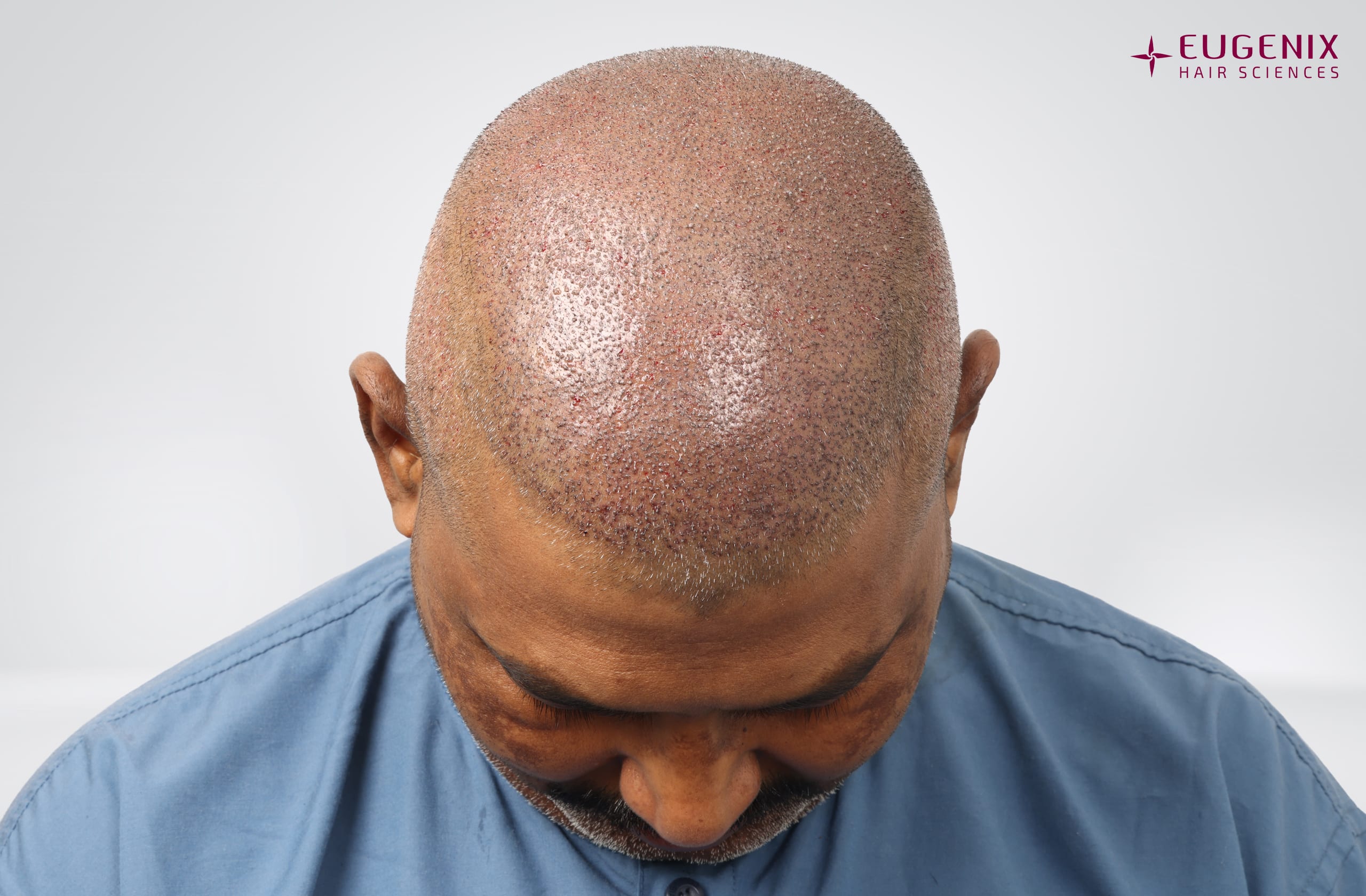Prem Anand Head Down Post-op copy