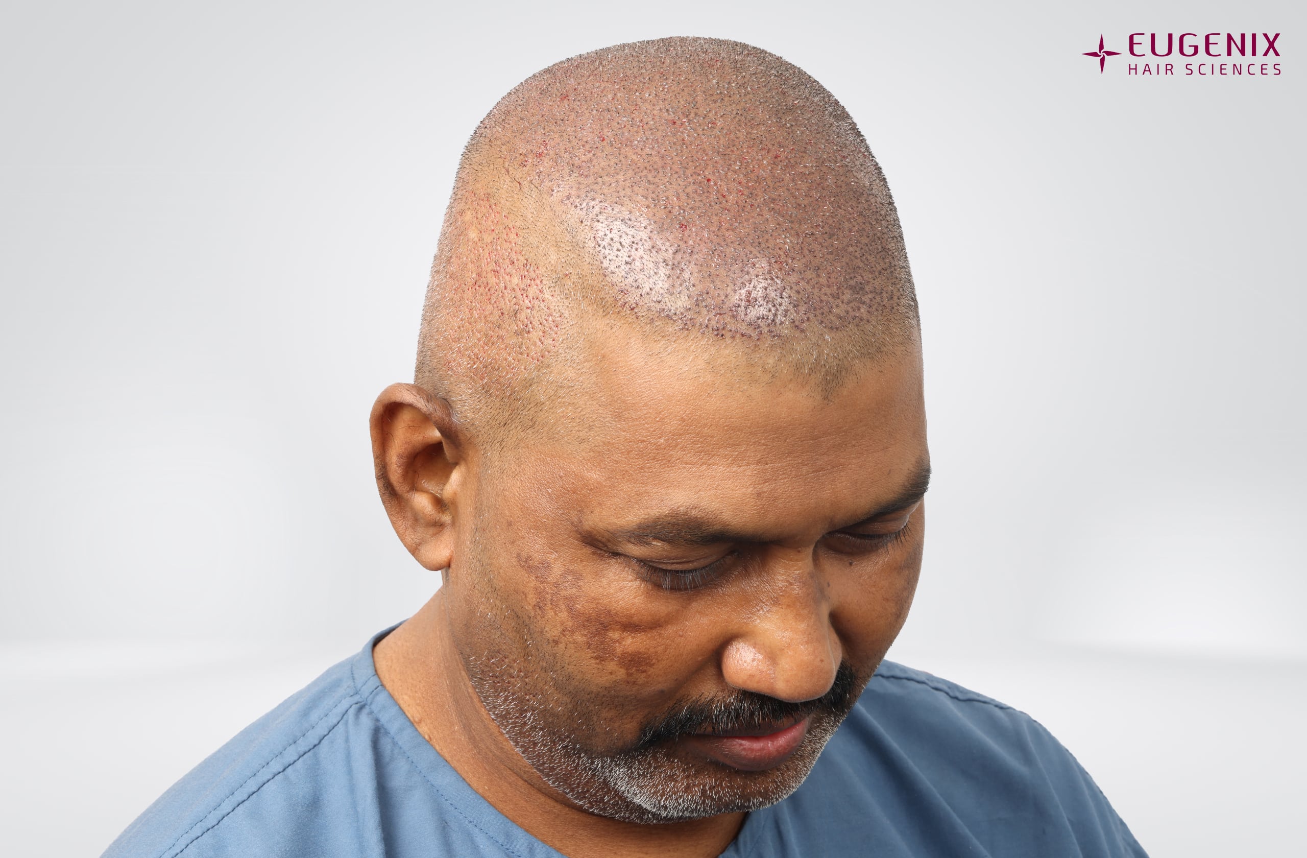 Prem Anand Left Post-op copy