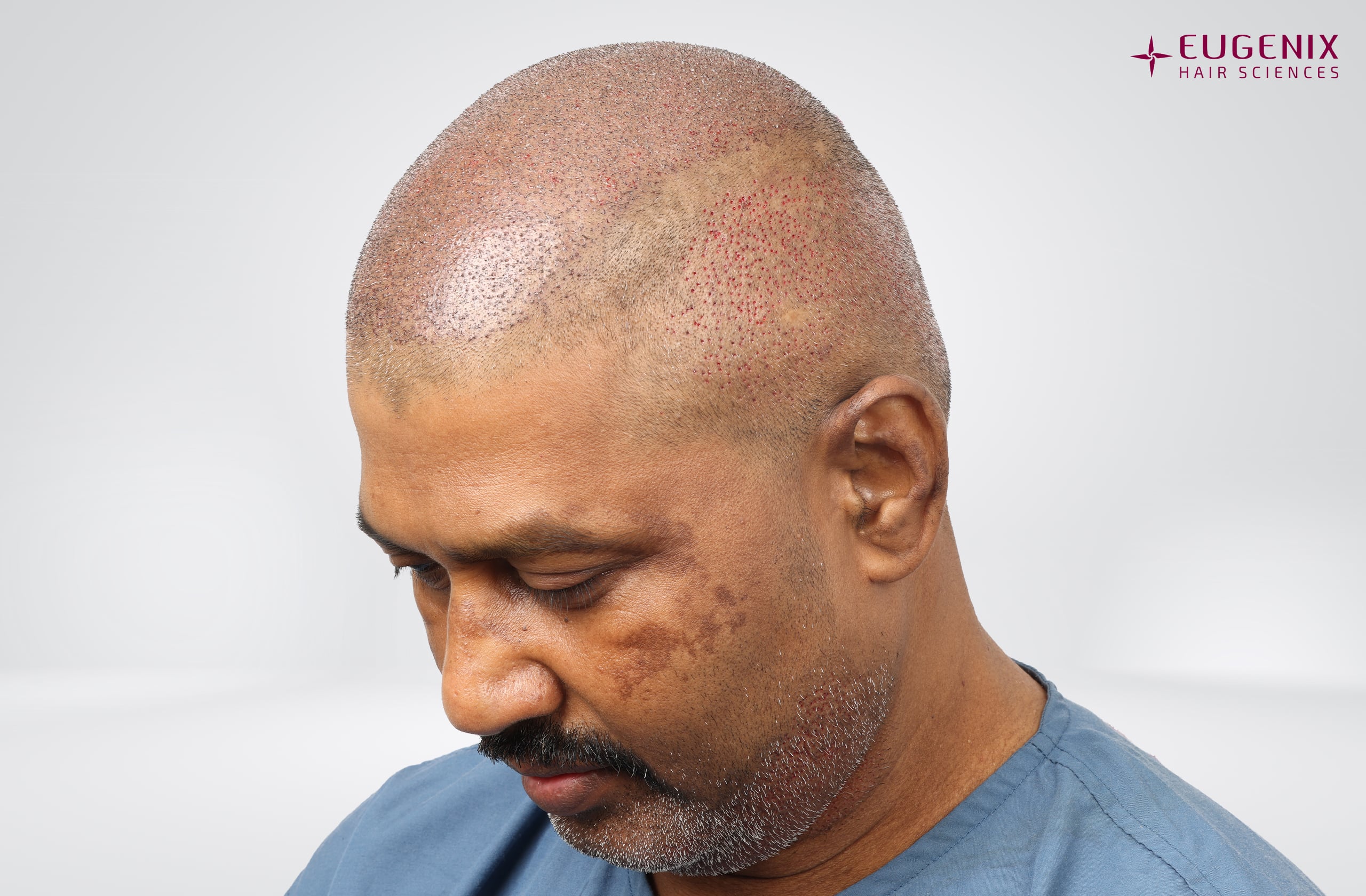 Prem Anand Right Post-op copy