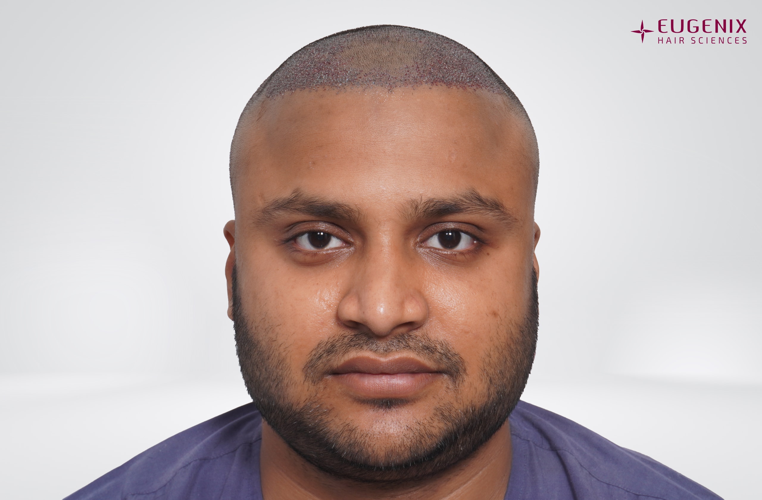 Tarun Garg Front Post-op copy