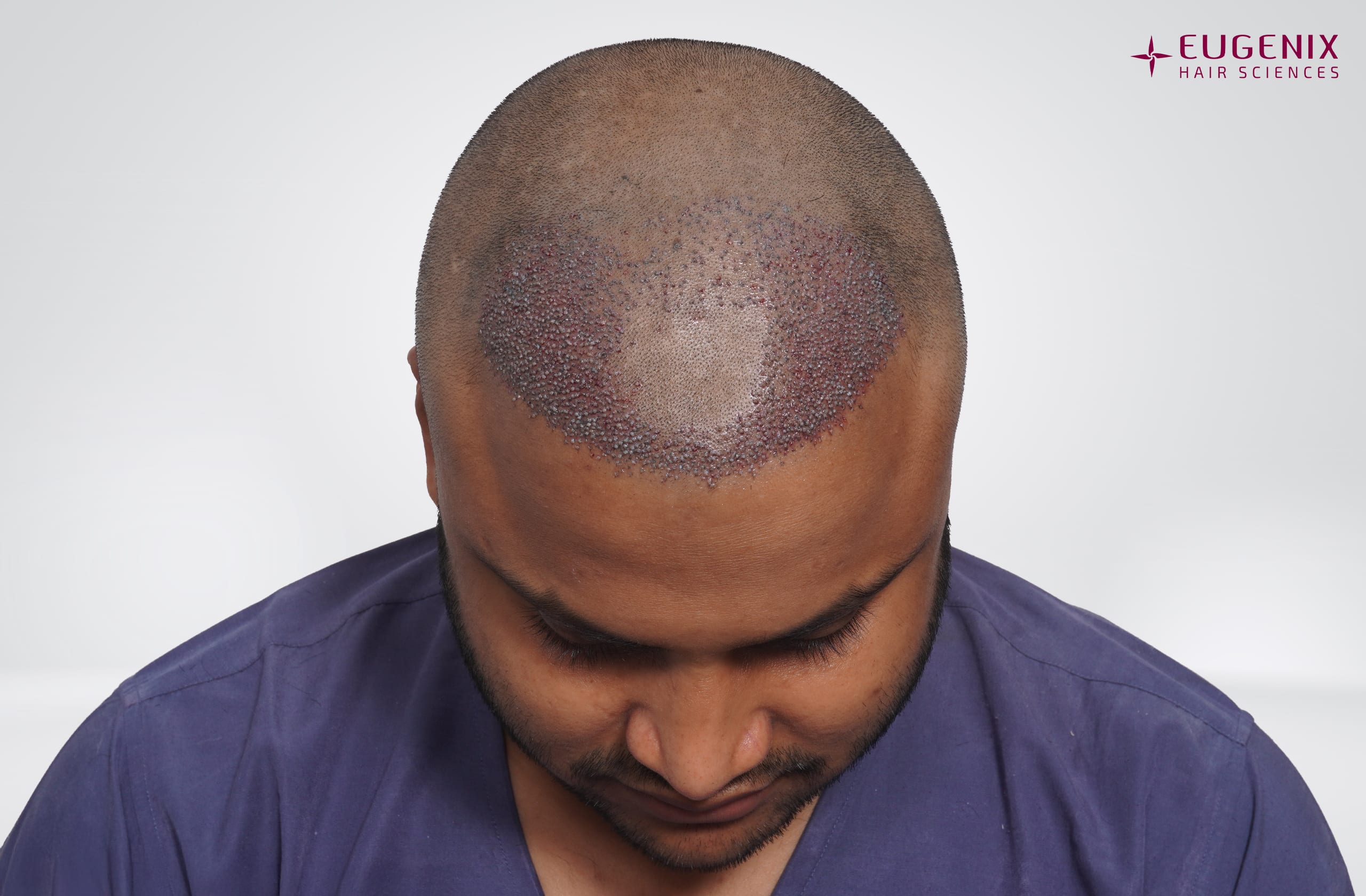 Tarun Garg Head Down Post-op copy