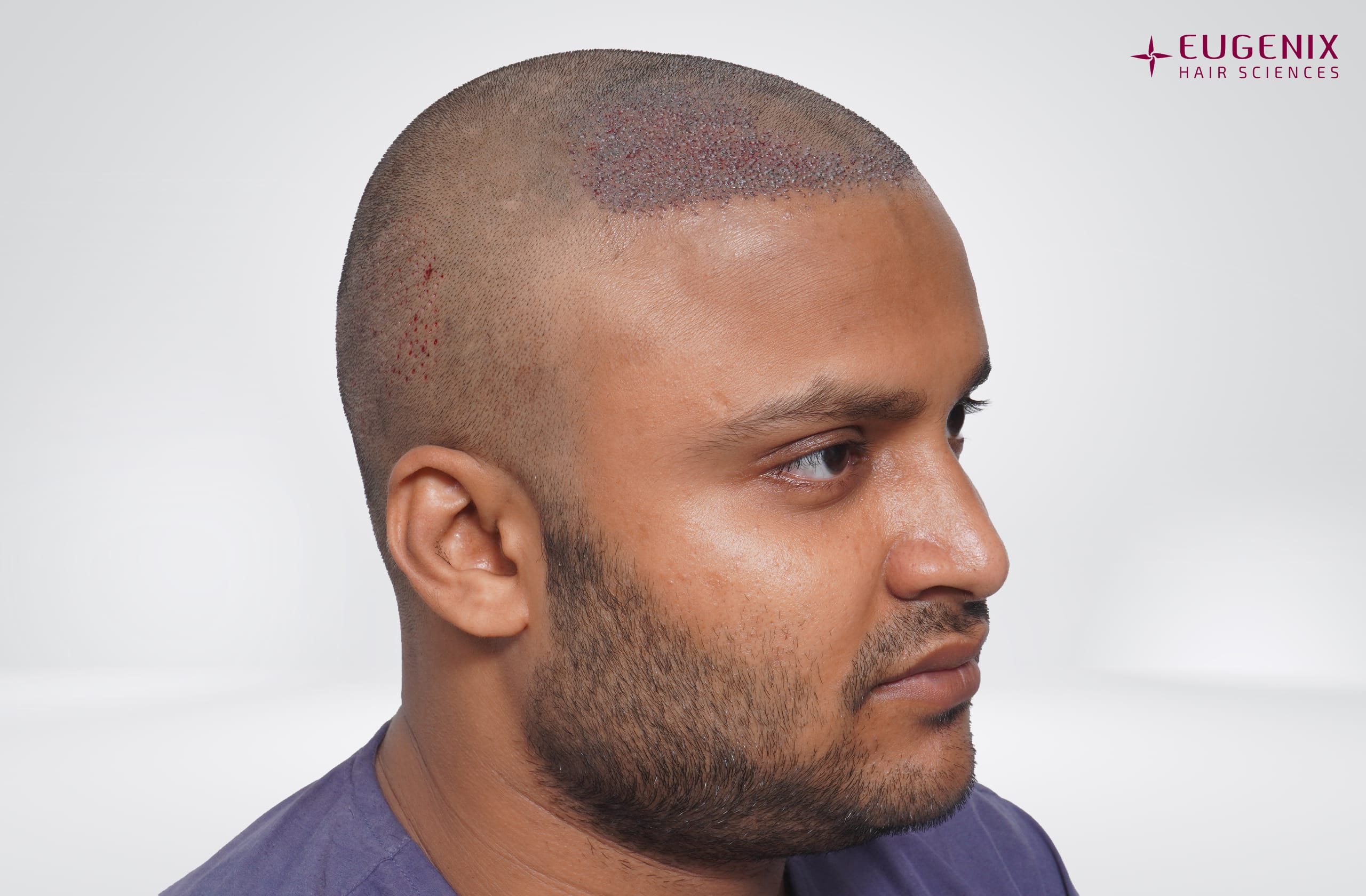 Tarun Garg Left Post-op copy