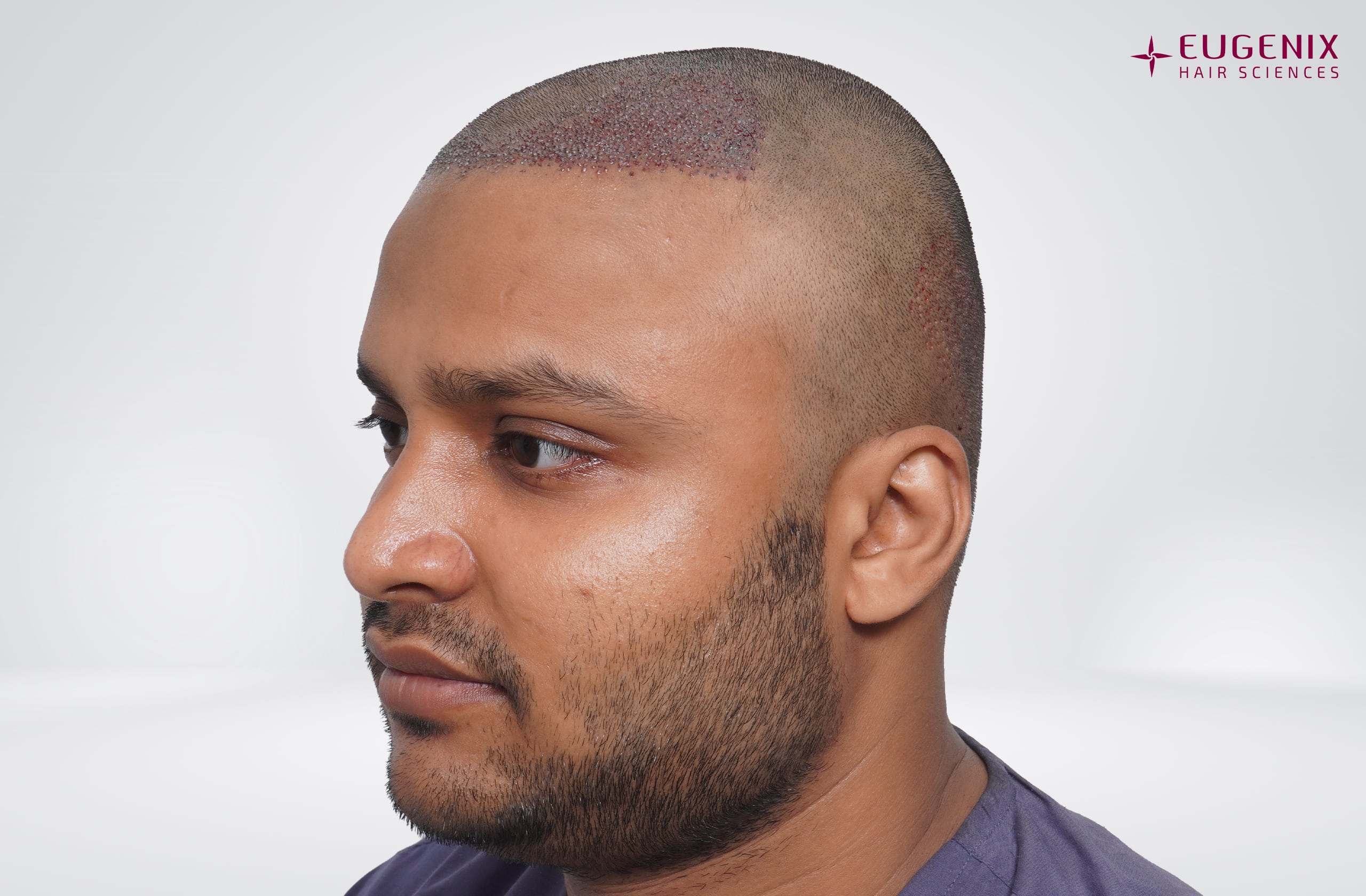 Tarun Garg Right Post-op copy