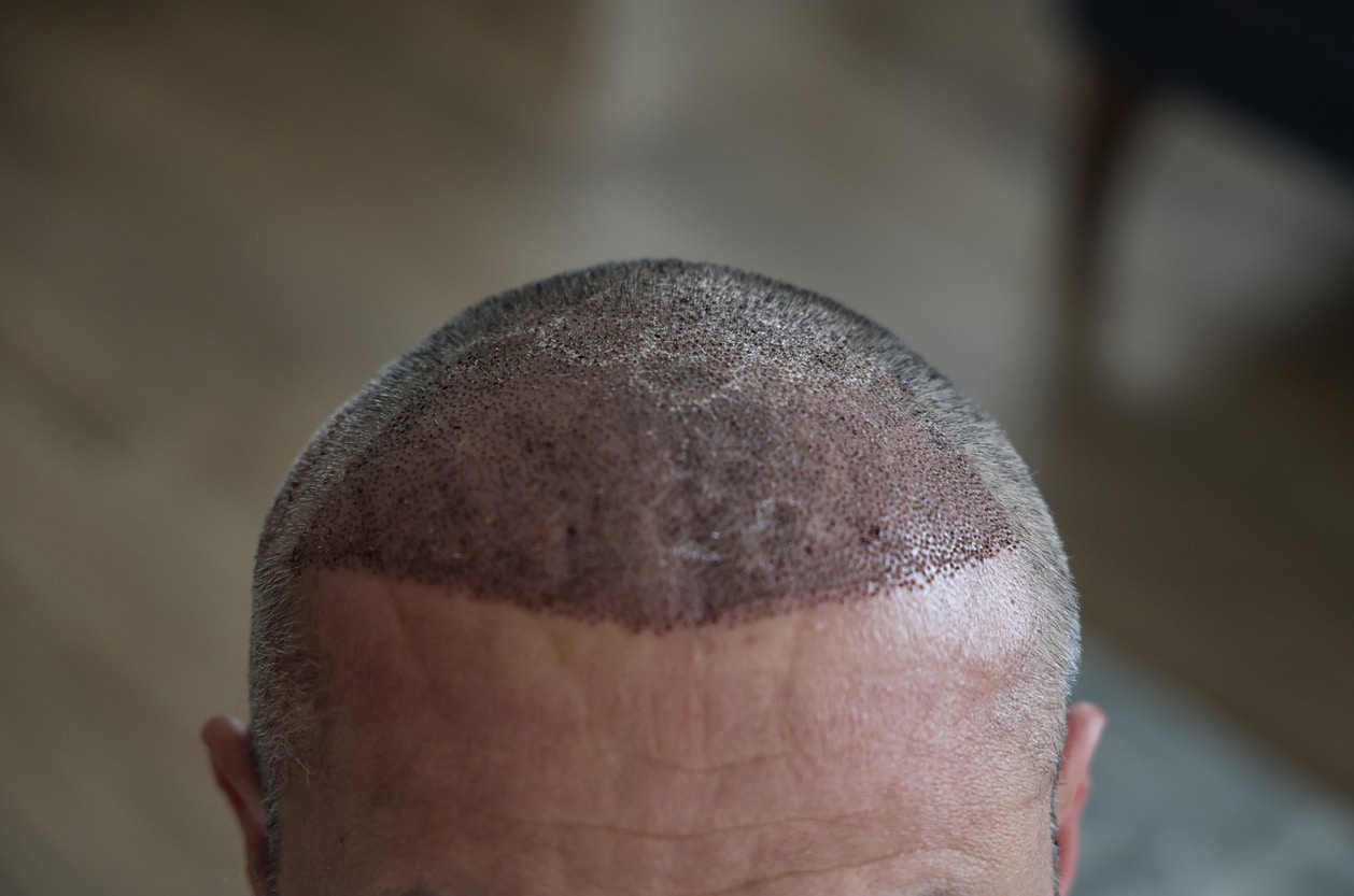 When Can You Wear a Hat or Helmet After a Hair Transplant?