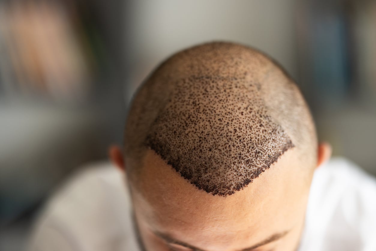 Gym and Sports After Hair Transplant: Your Complete Exercise Recovery Guide