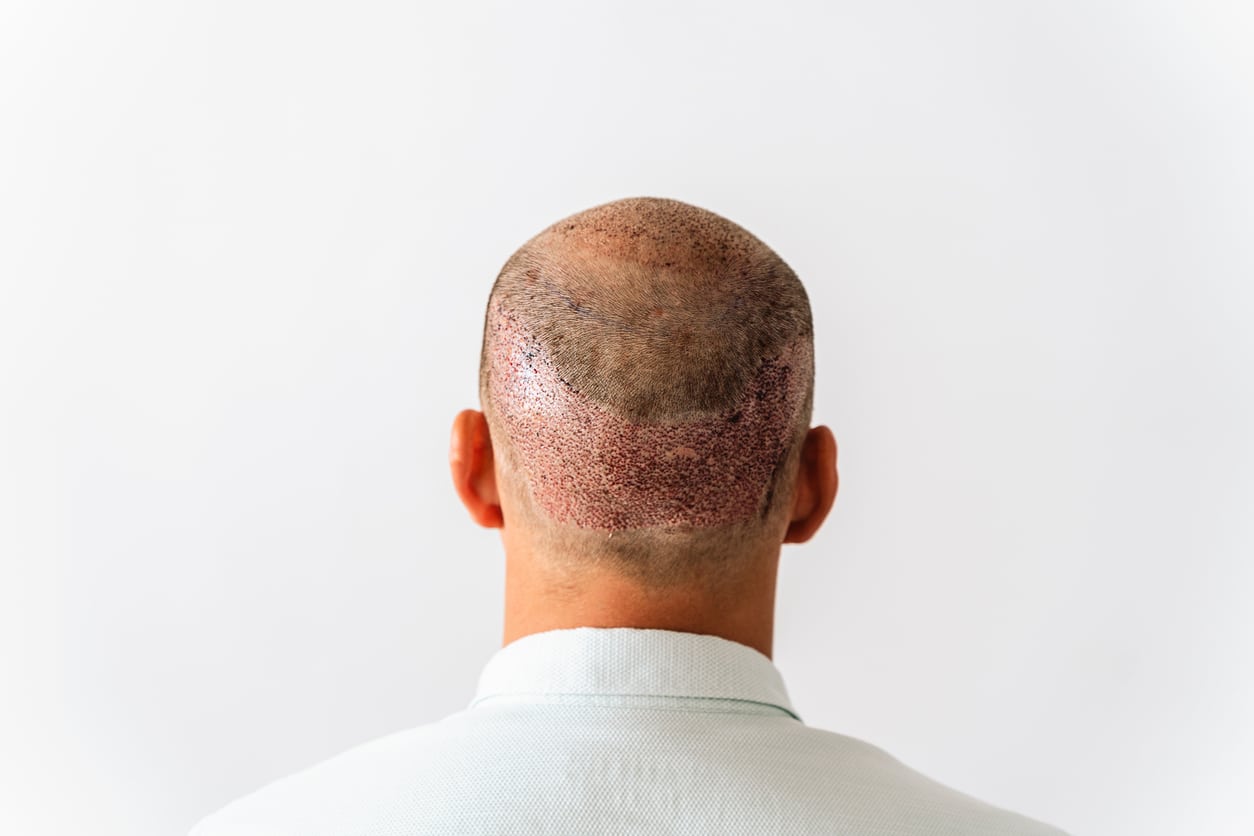 Swimming and Sun Exposure After Hair Transplant: Timeline, Risks and Recovery Guidelines
