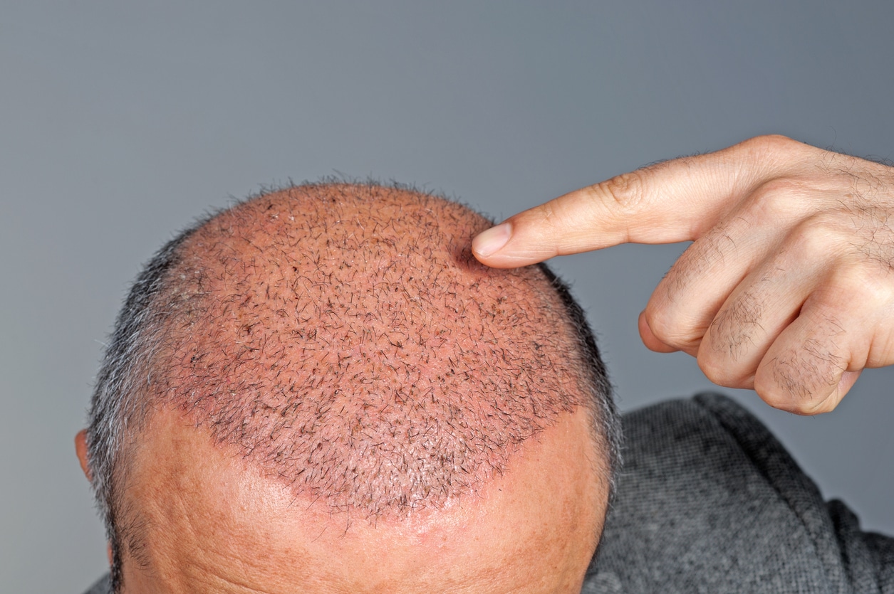 Sleeping After Hair Transplant: The Complete 7 to 10 Day Recovery Guide