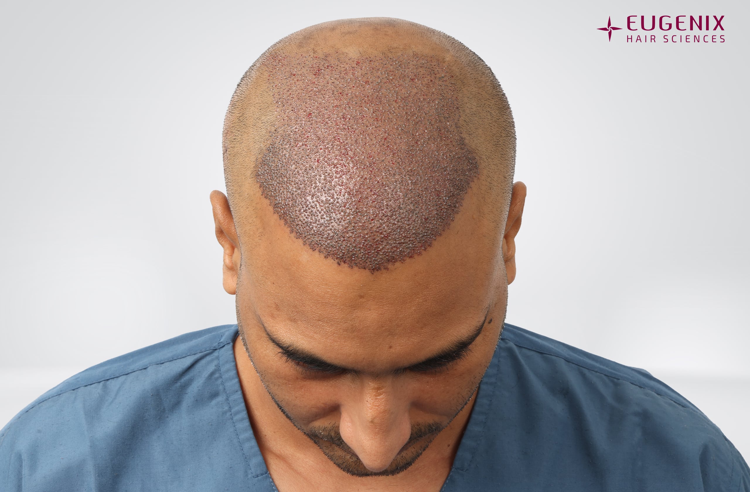 Avinash Post-op Head Down copy