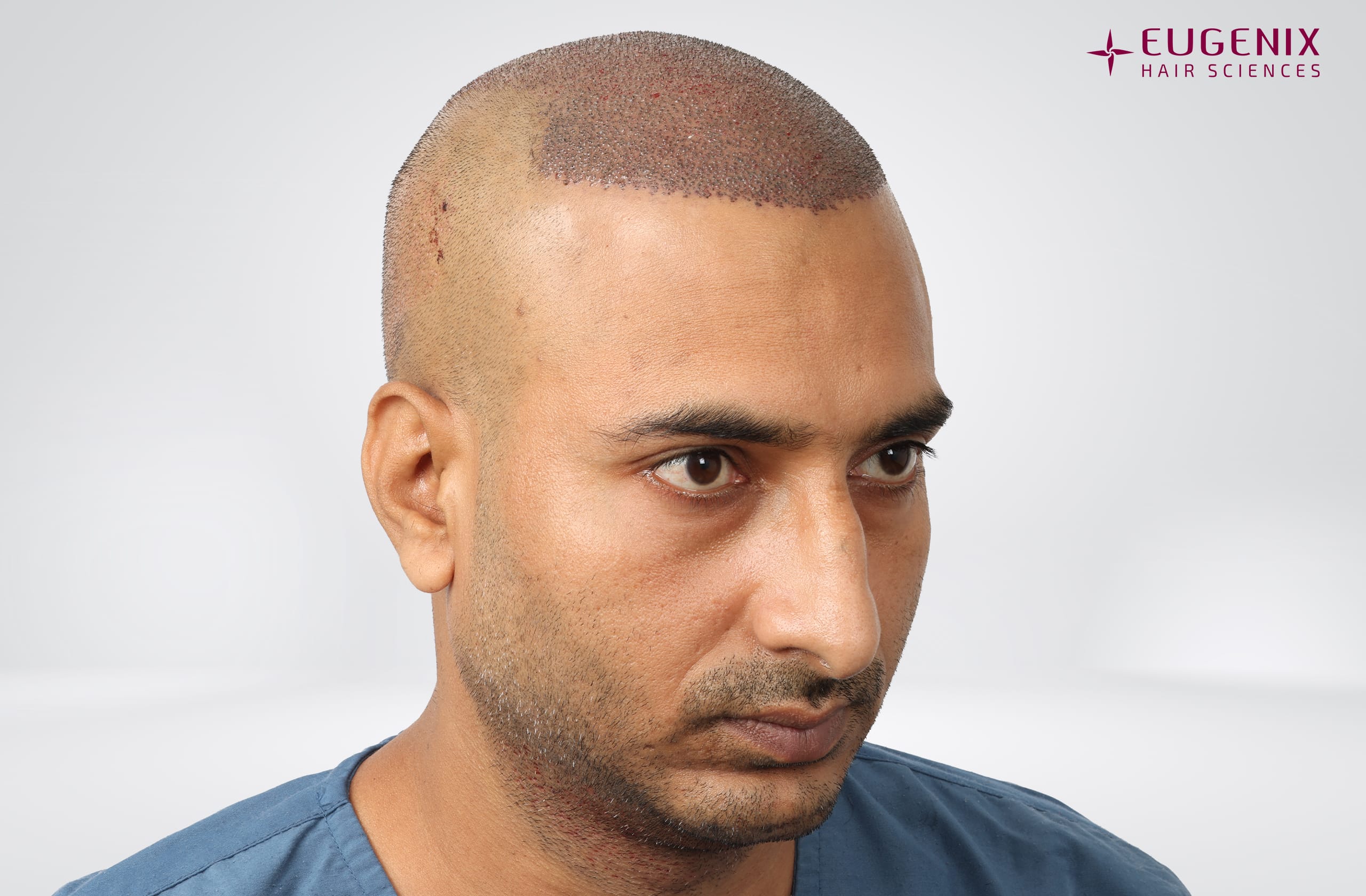 Avinash Post-op Left copy