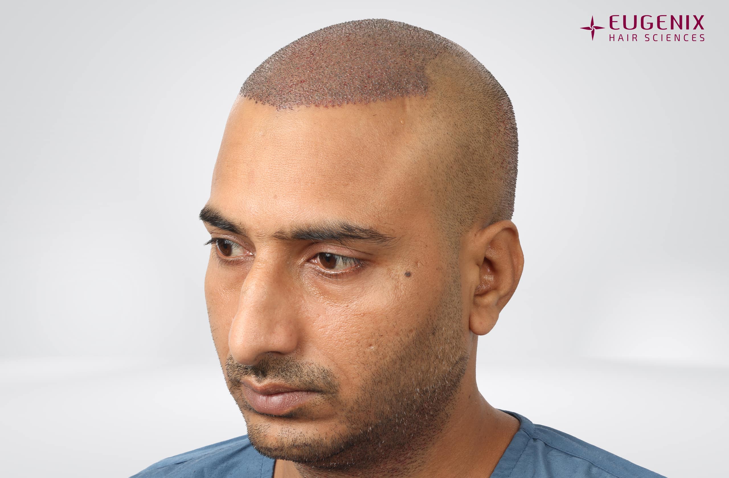 Avinash Post-op Right copy