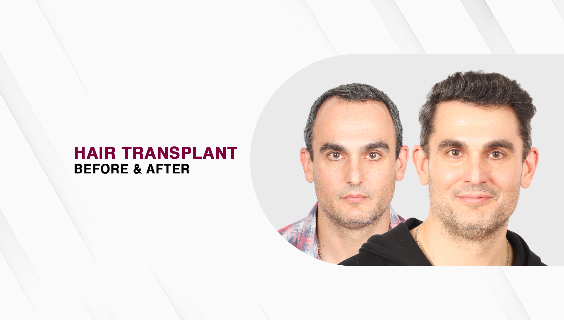 Hair Transplant Before and After: A Realistic Look at Hair Transplant Results, Timeline, and What to Truly Expect