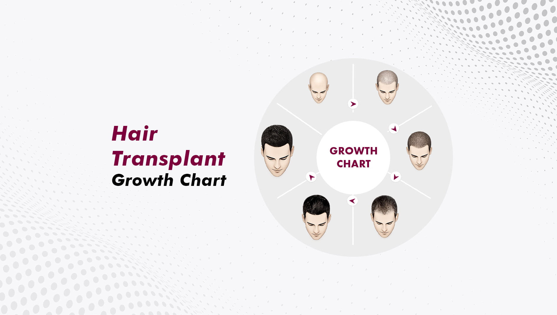 Hair Transplant Growth Chart: Month-by-Month Timeline of Results