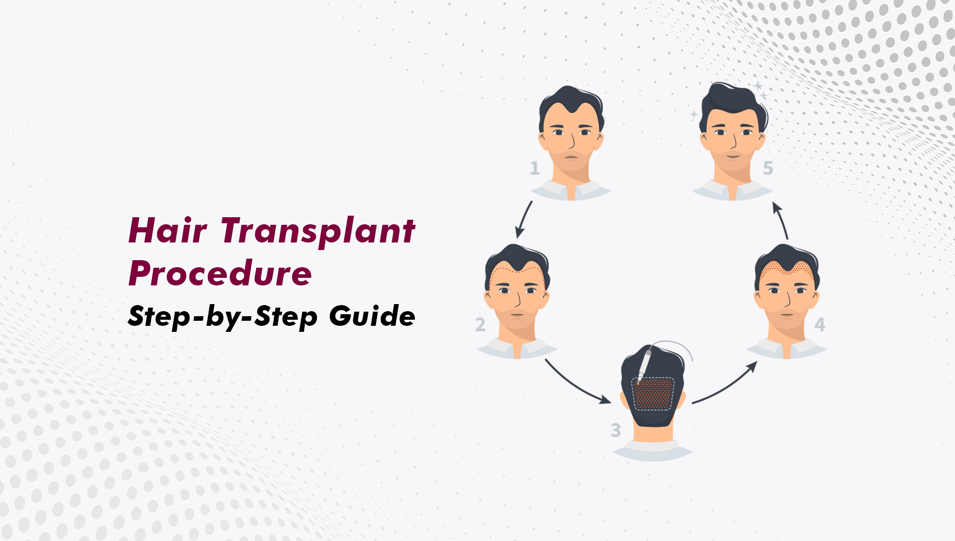 Hair Transplant Procedure: A Complete Step-by-Step Guide