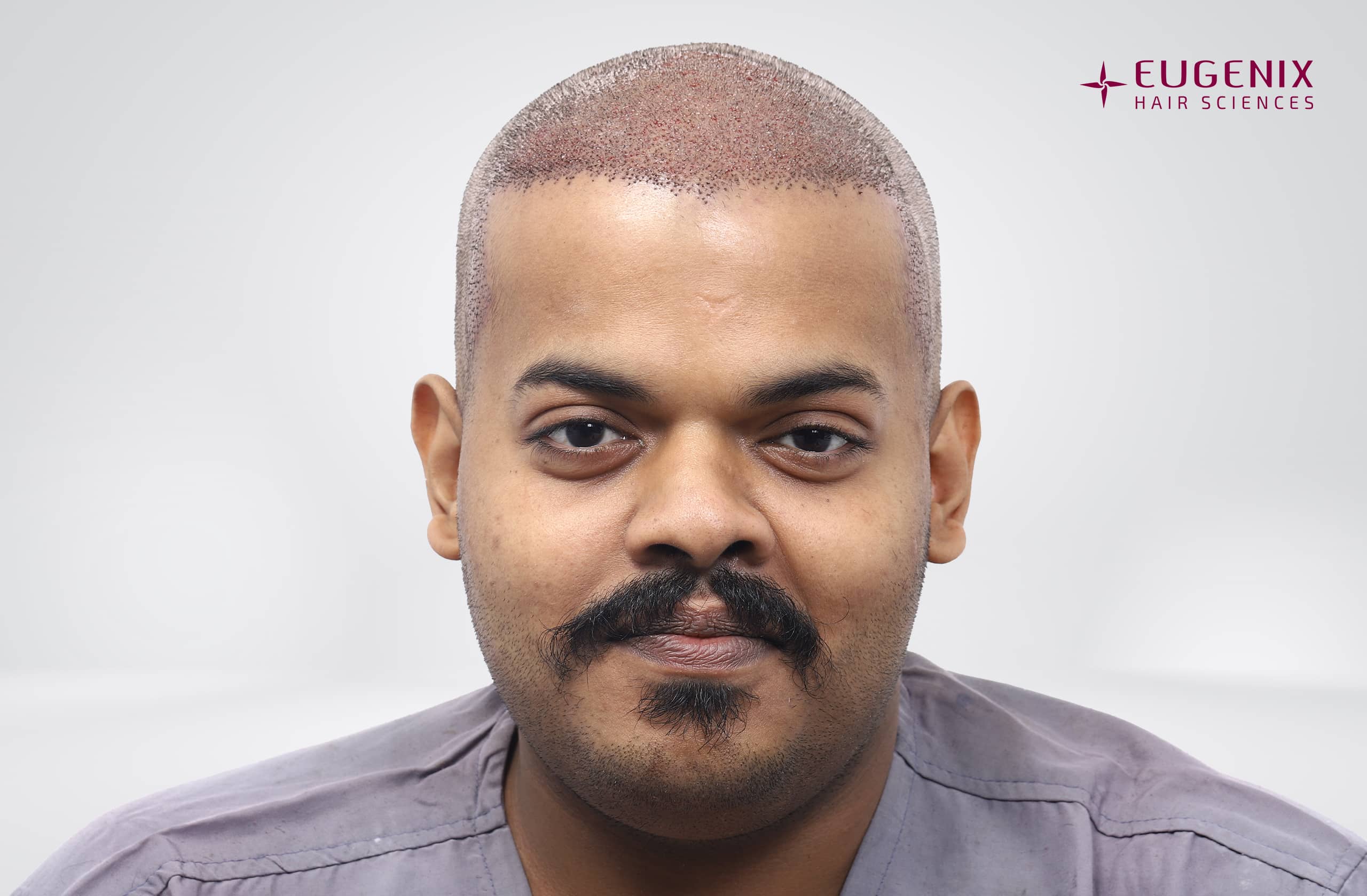 Harivishnu D Post-op Front copy