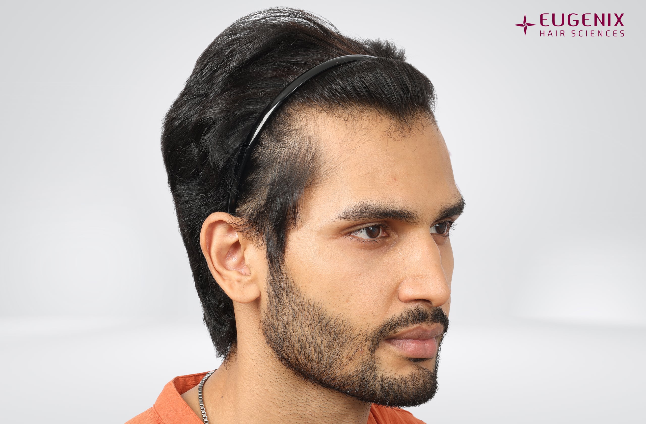 Rohit Khandelwal Before Left copy