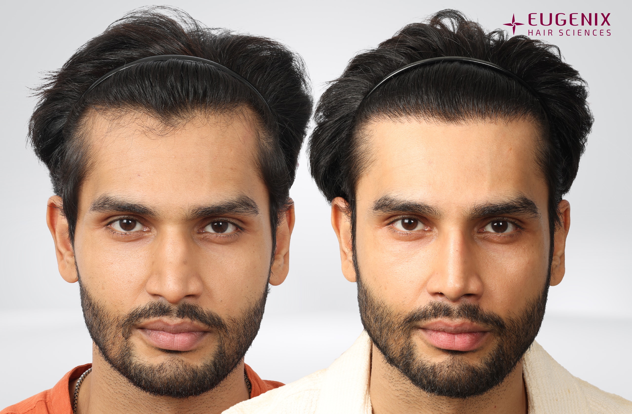 Rohit Khandelwal Before and After Front copy