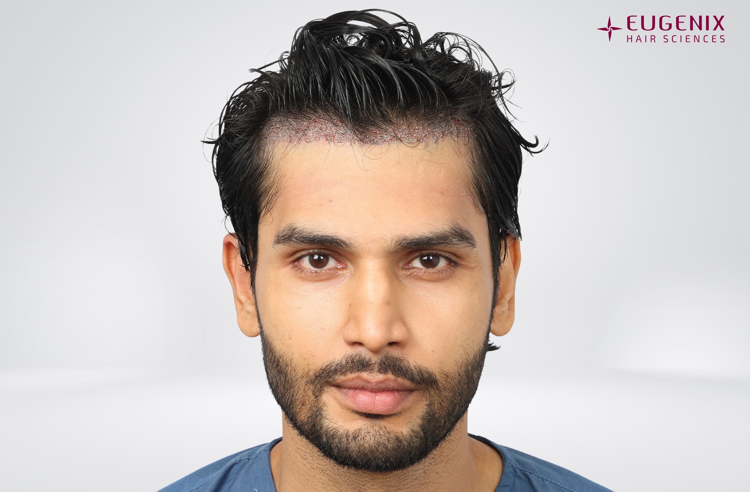 Rohit Khandelwal Post-op Front copy
