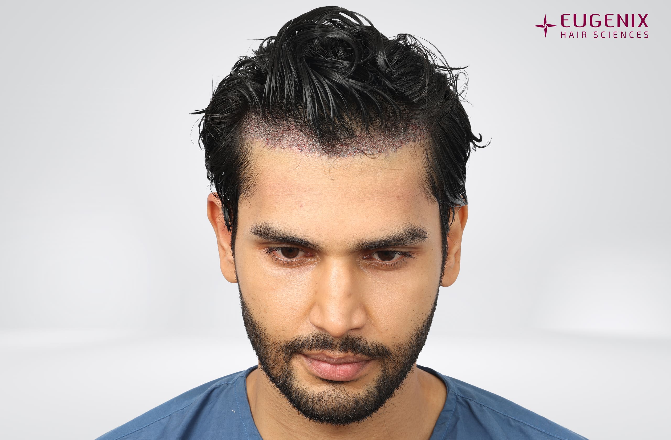 Rohit Khandelwal Post-op Head Down copy