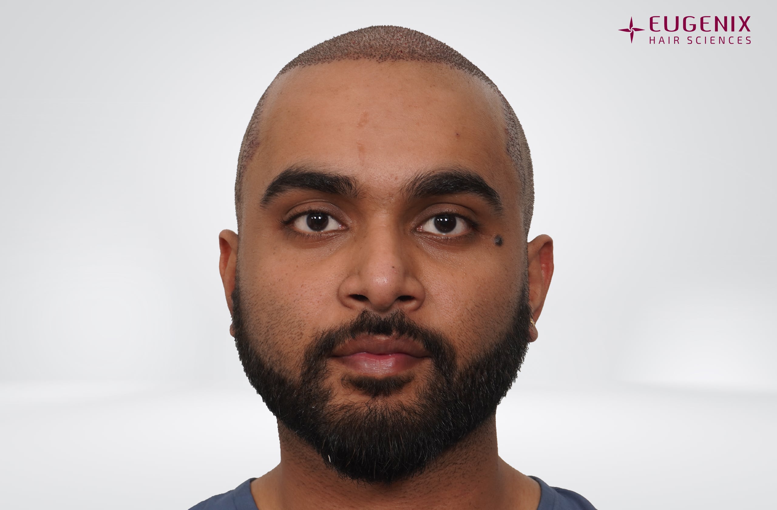 Suyash Srivastava Post-op Front copy