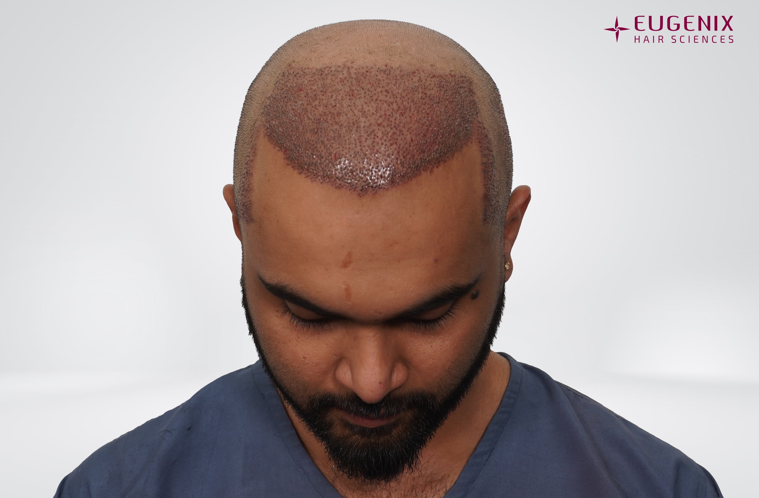 Suyash Srivastava Post-op Head Down copy