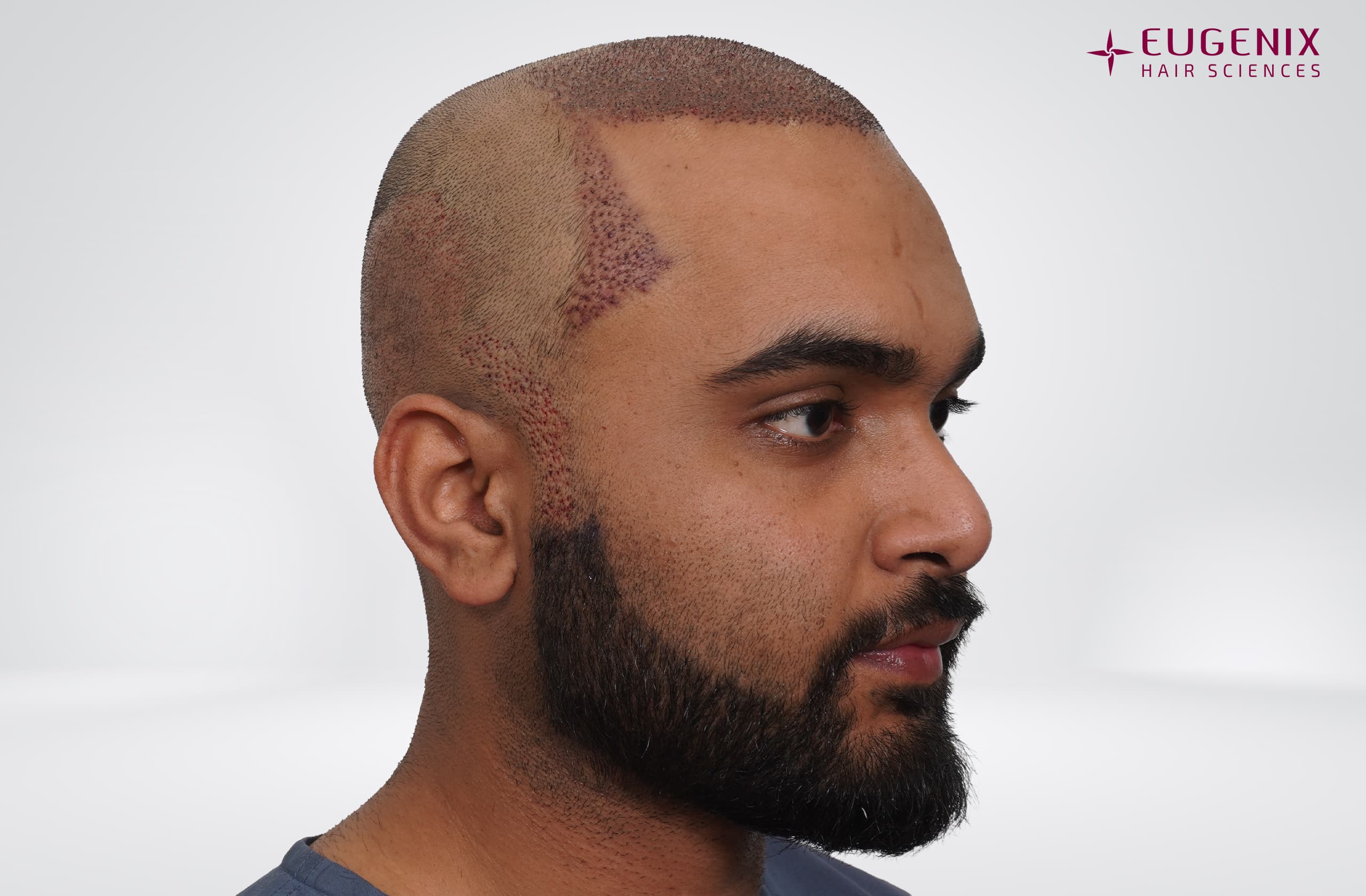 Suyash Srivastava Post-op Left copy