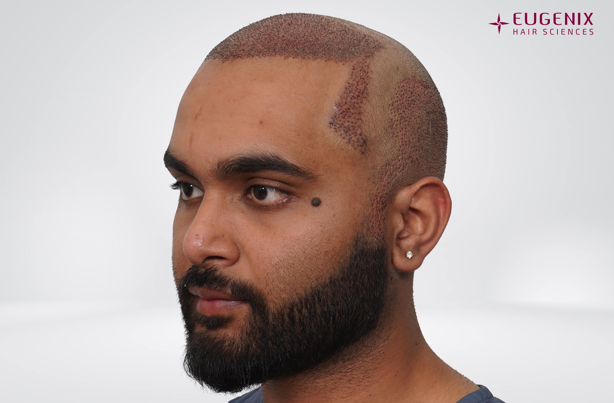 Suyash Srivastava Post-op Right copy