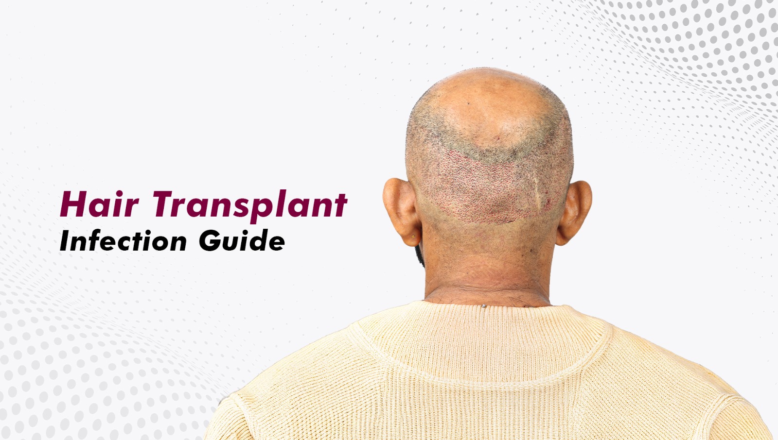Hair Transplant Infection: Causes, Signs, Prevention and Treatment