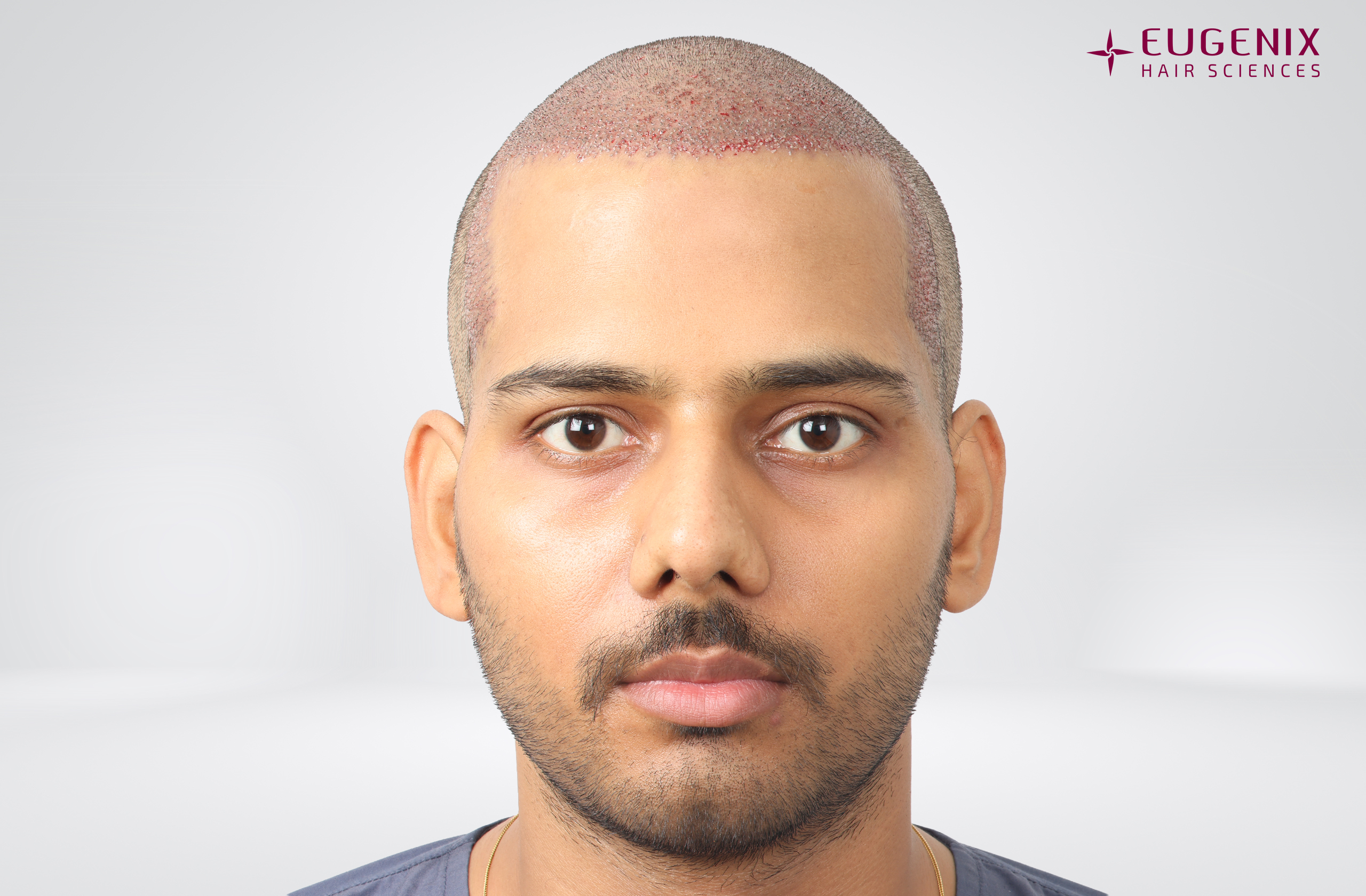 Devanshu Mishra Post-op Front copy