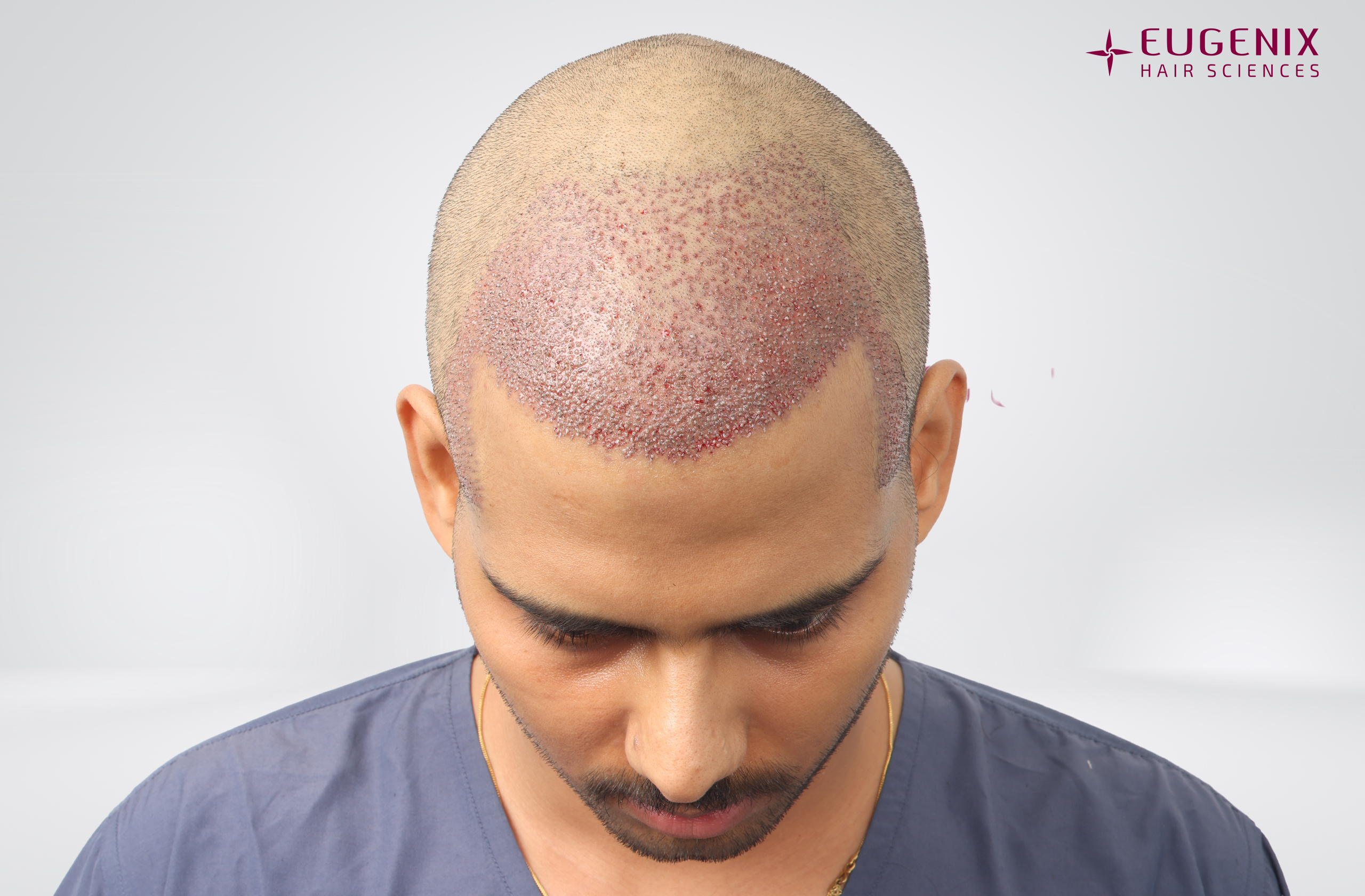 Devanshu Mishra Post-op Head Down copy