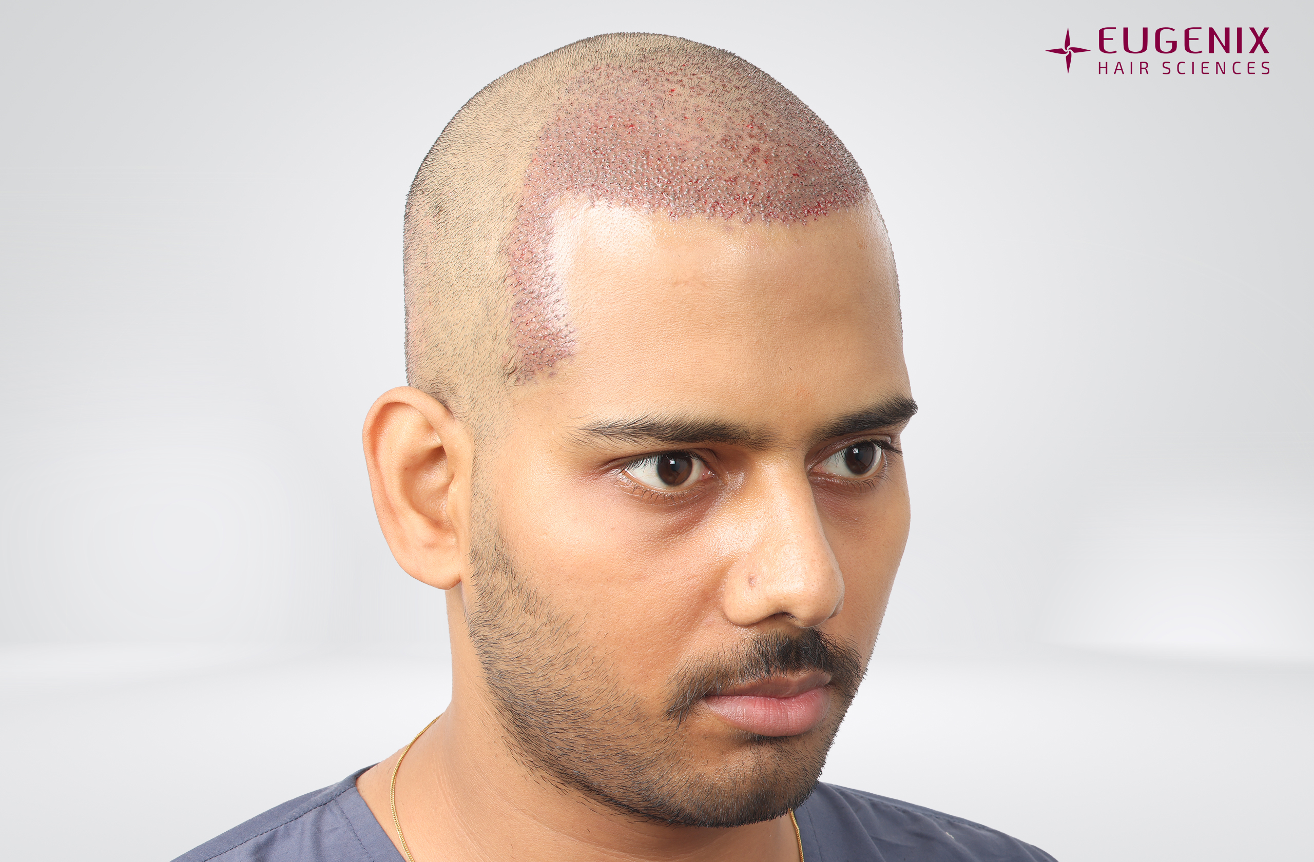 Devanshu Mishra Post-op Left copy