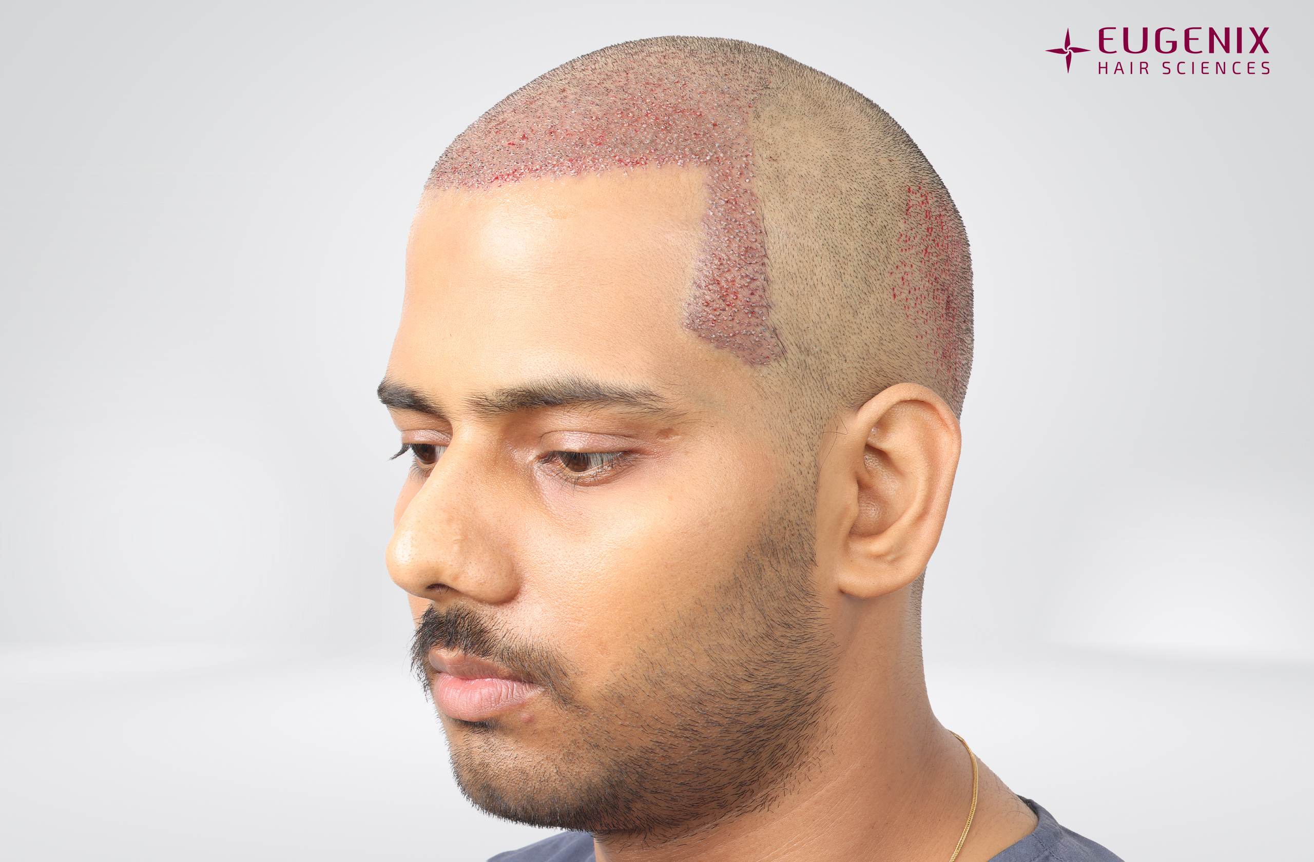 Devanshu Mishra Post-op Right copy