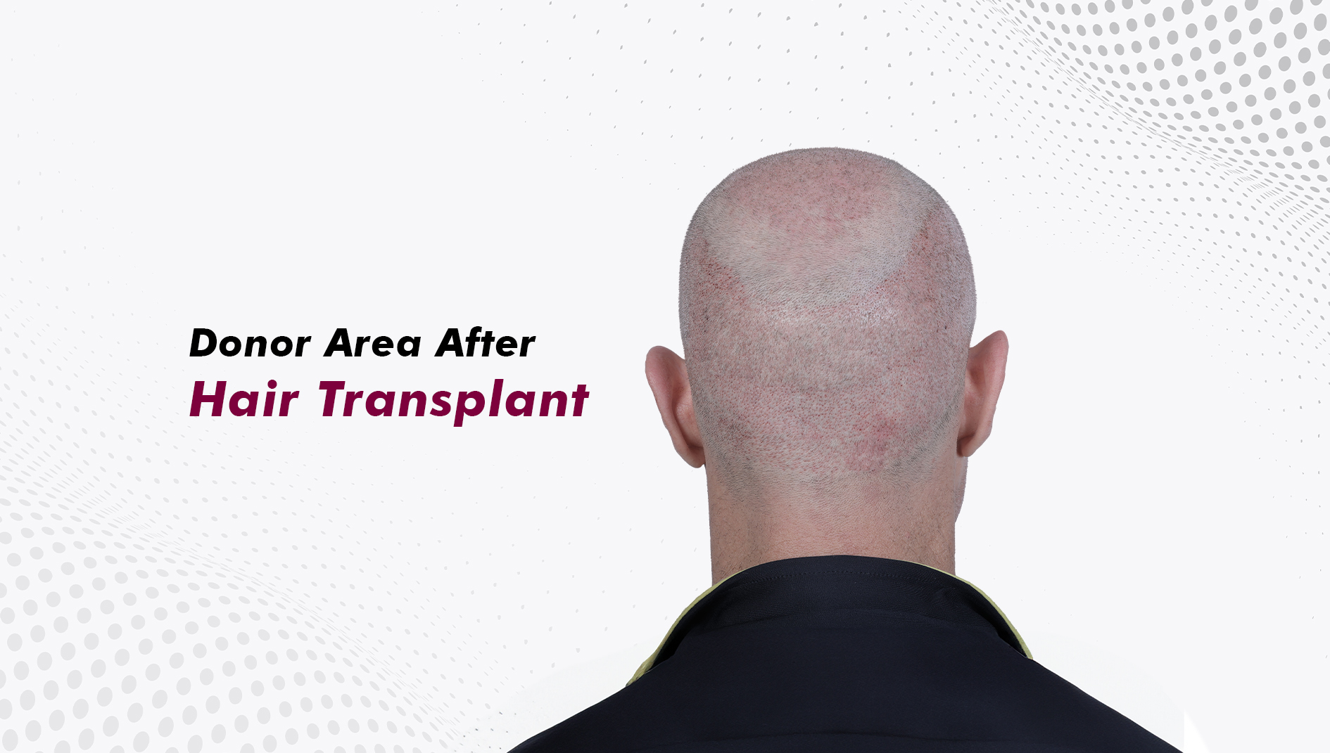 What Happens to the Donor Area After a Hair Transplant?