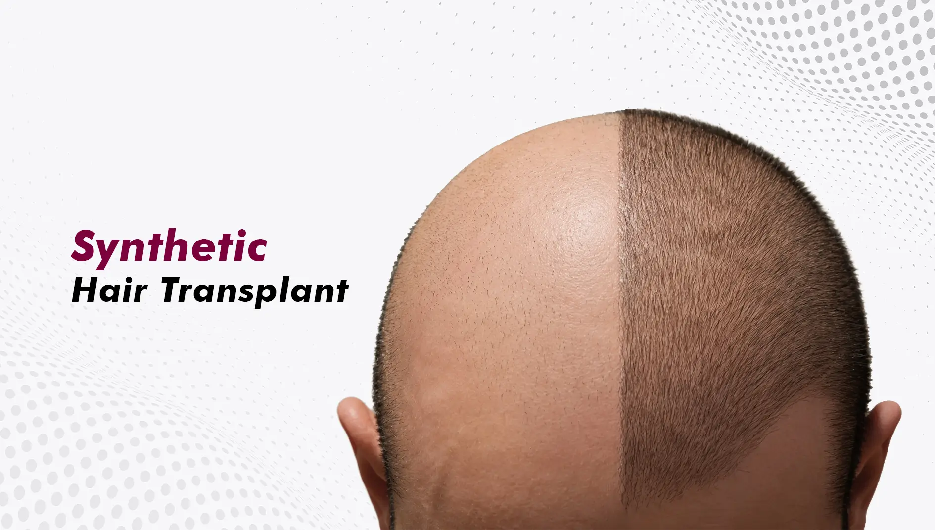 Are Synthetic Hair Transplants Safe? The Honest Science Behind Artificial Hair
