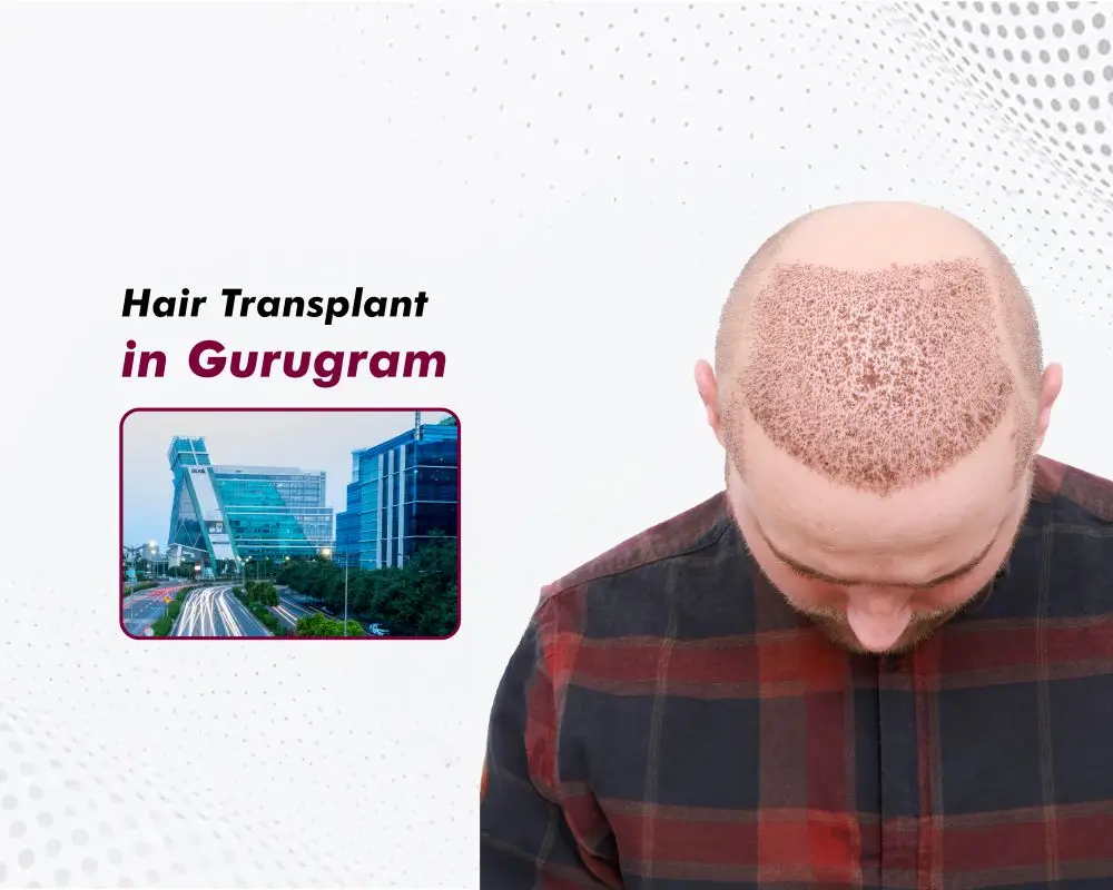 Hair Transplant in Gurugram