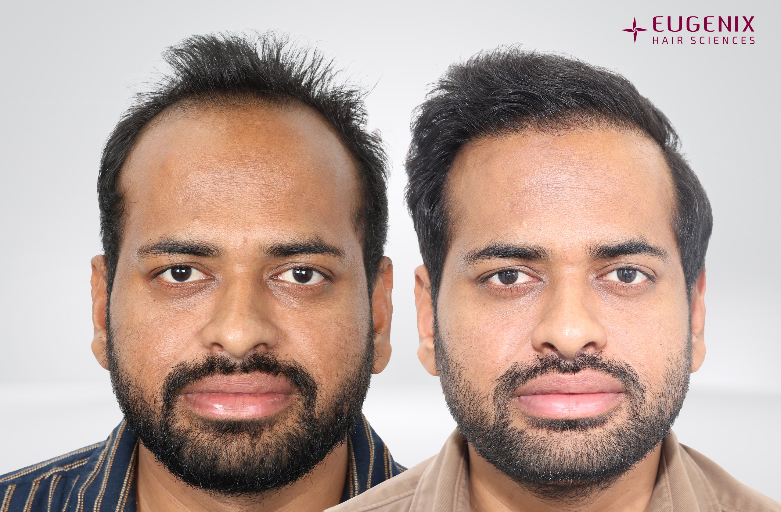 Kolanupaka Vishnu Vardhan Before and After Front copy