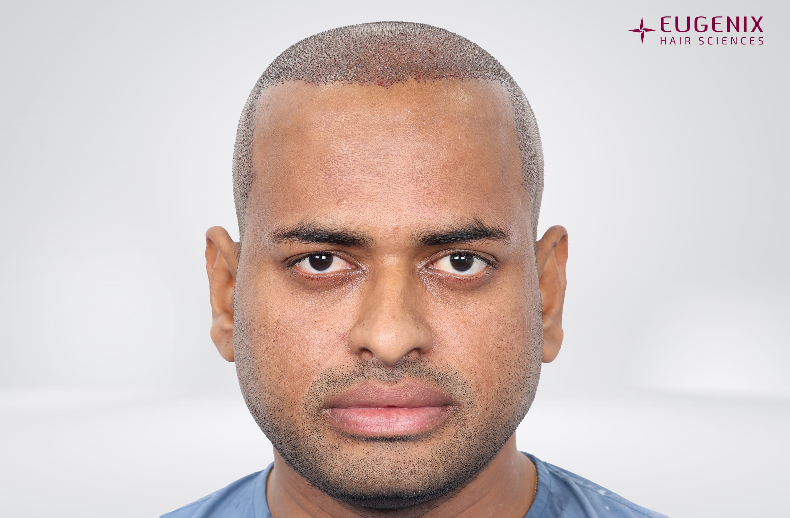 Kolanupaka Vishnu Vardhan Post-op Front copy