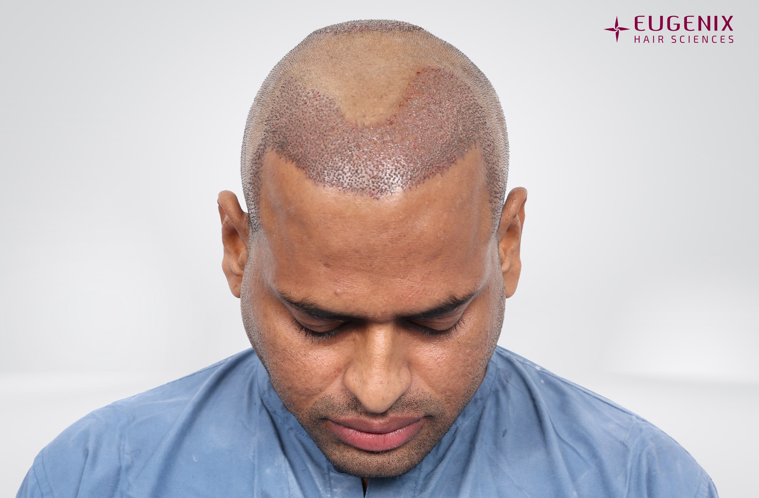 Kolanupaka Vishnu Vardhan Post-op Head Down copy